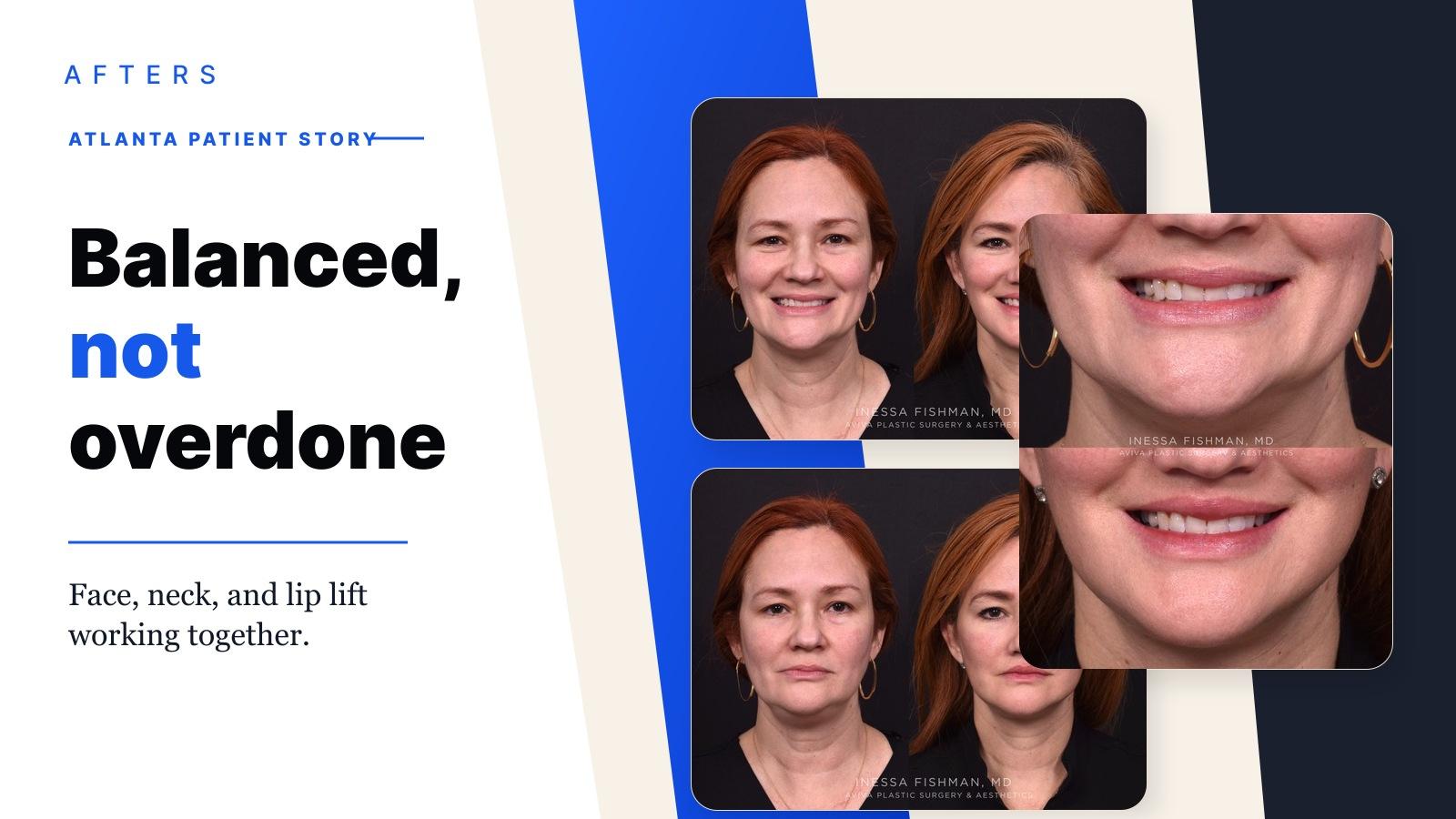 Afters cover for an Atlanta balanced facial rejuvenation Reddit story