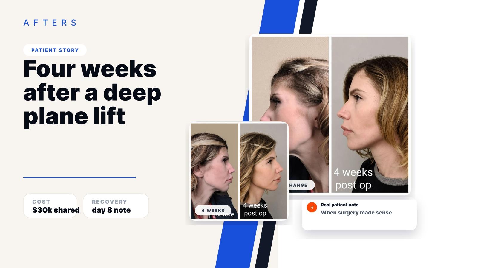 Afters blog cover for a four-week deep plane face and neck lift Reddit patient story