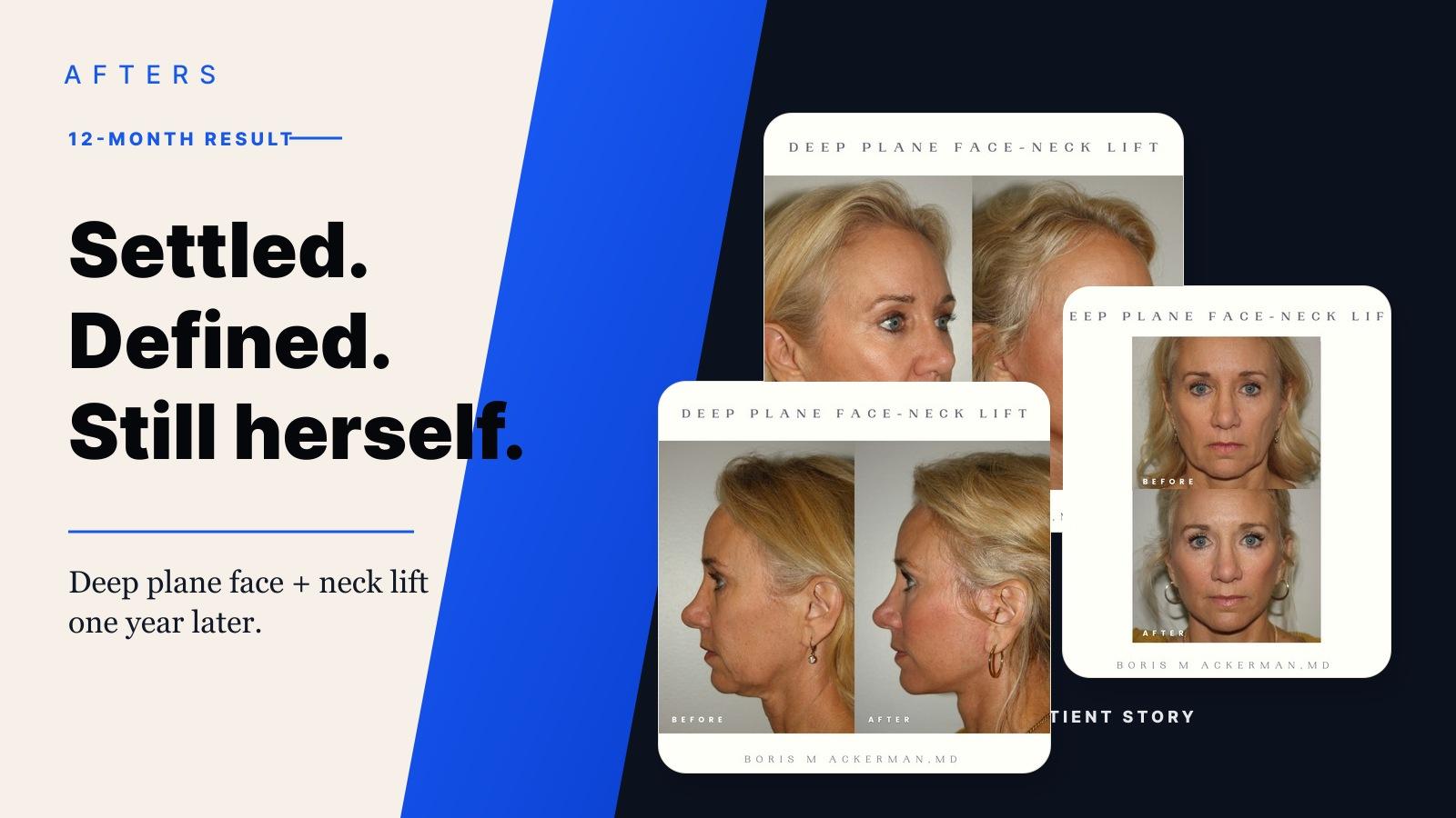 Afters cover for a 12-month Orange County deep plane face and neck lift story