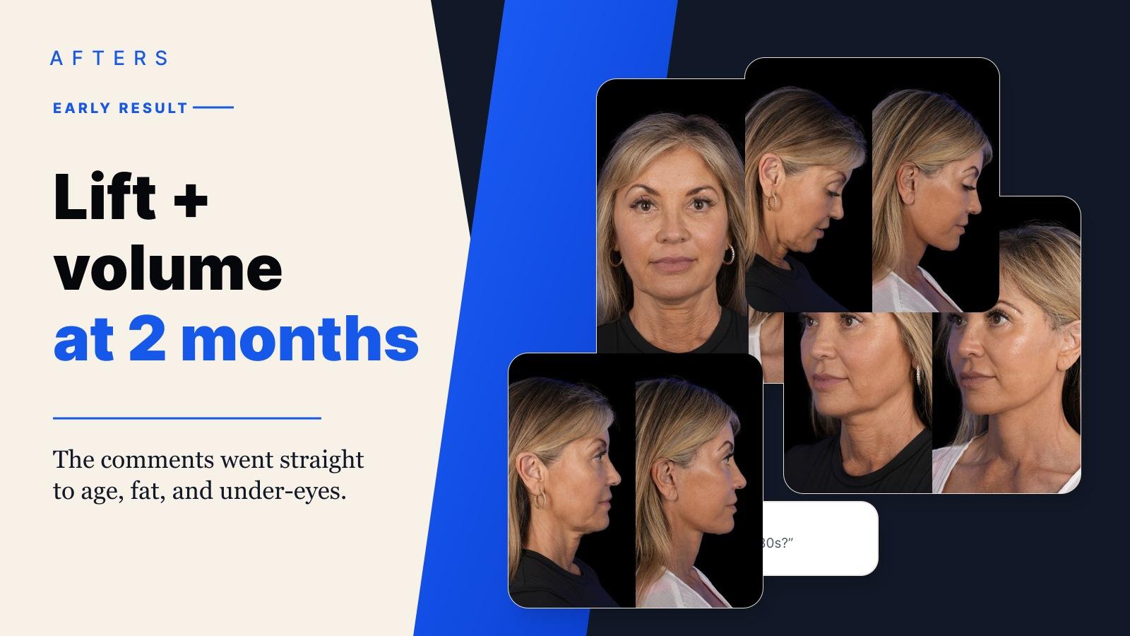 Afters cover for a deep plane facelift and fat grafting result at 2 months
