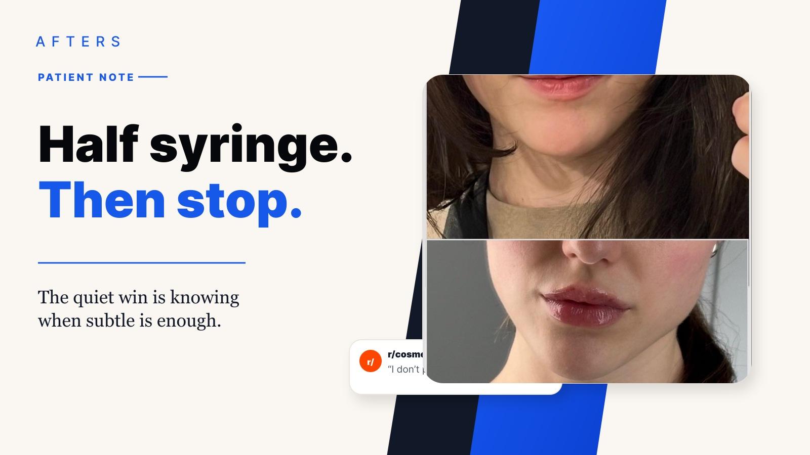 Afters cover for a natural lip filler before-and-after patient story