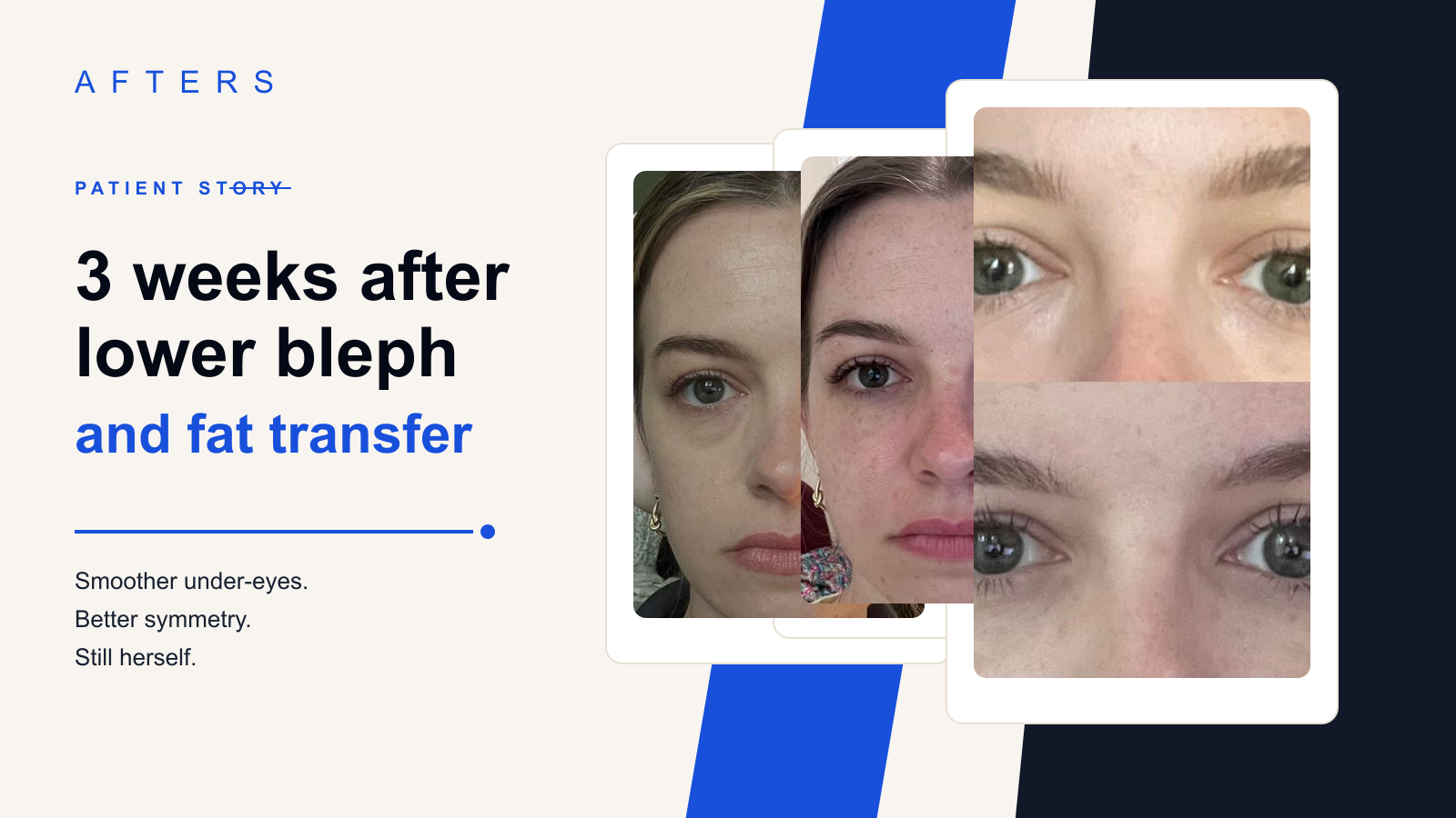 Eyelid surgery result browsing card