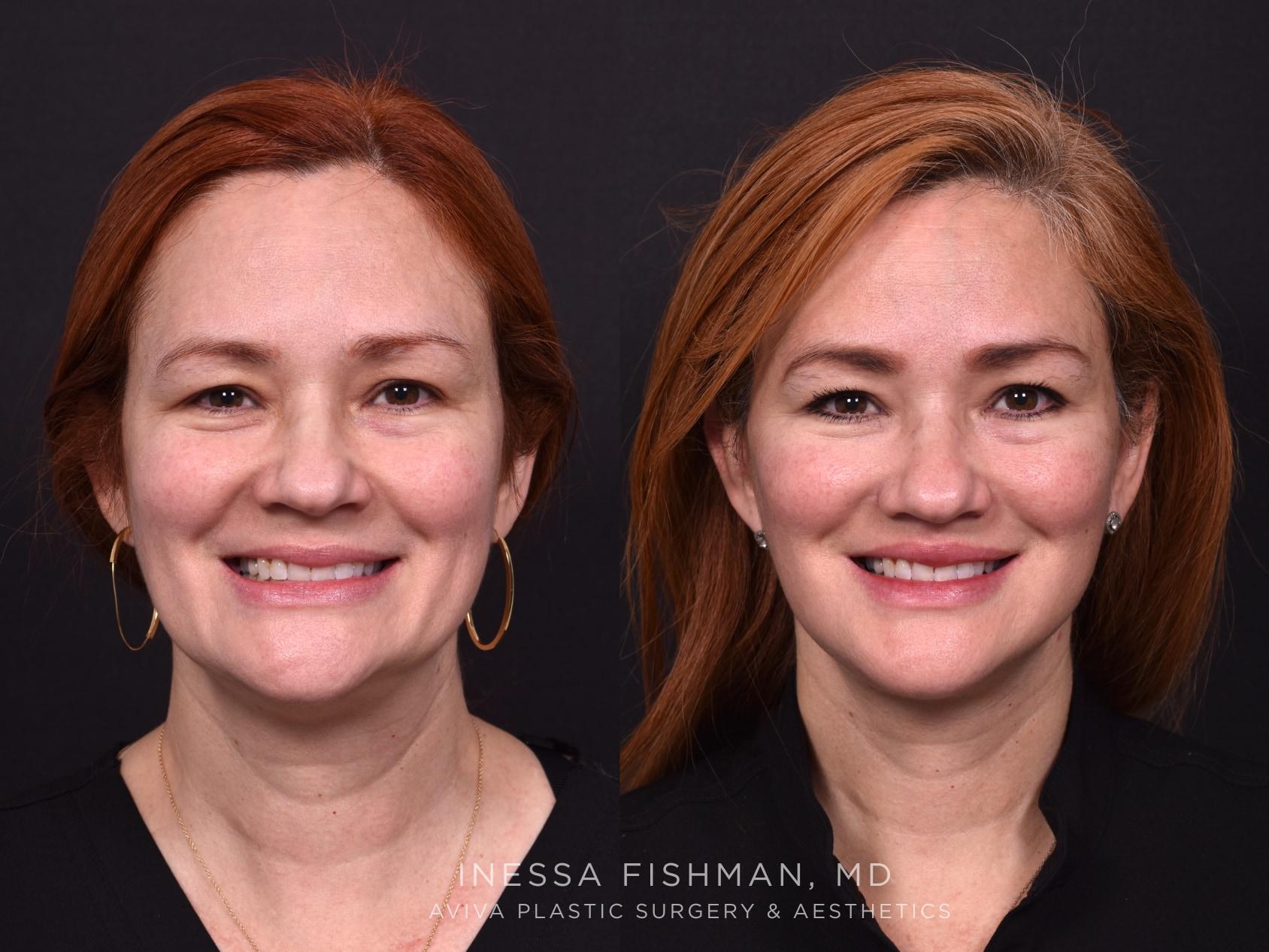 Smiling before-and-after from an Atlanta facial rejuvenation case