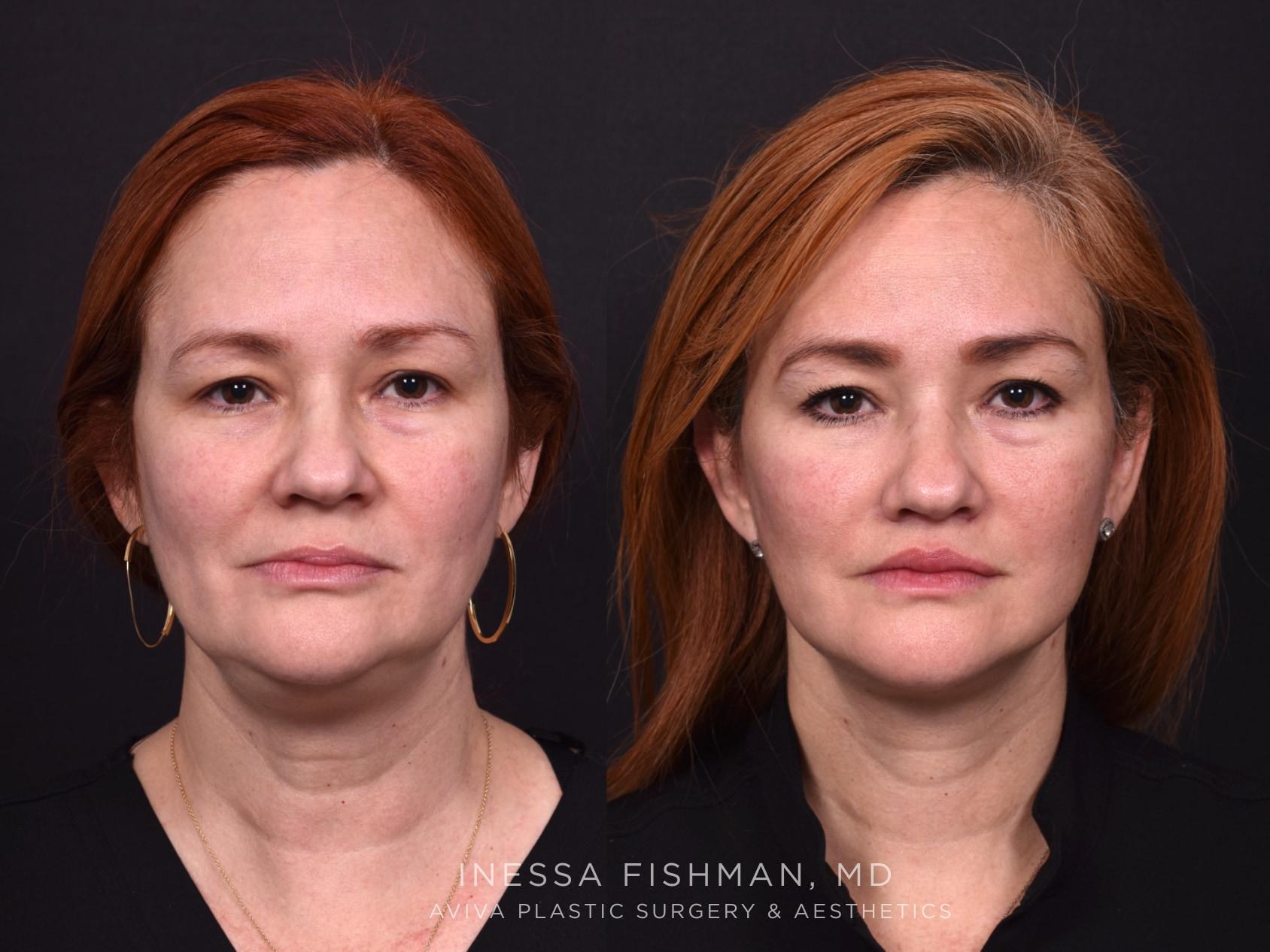 Neutral before-and-after from an Atlanta facial rejuvenation case