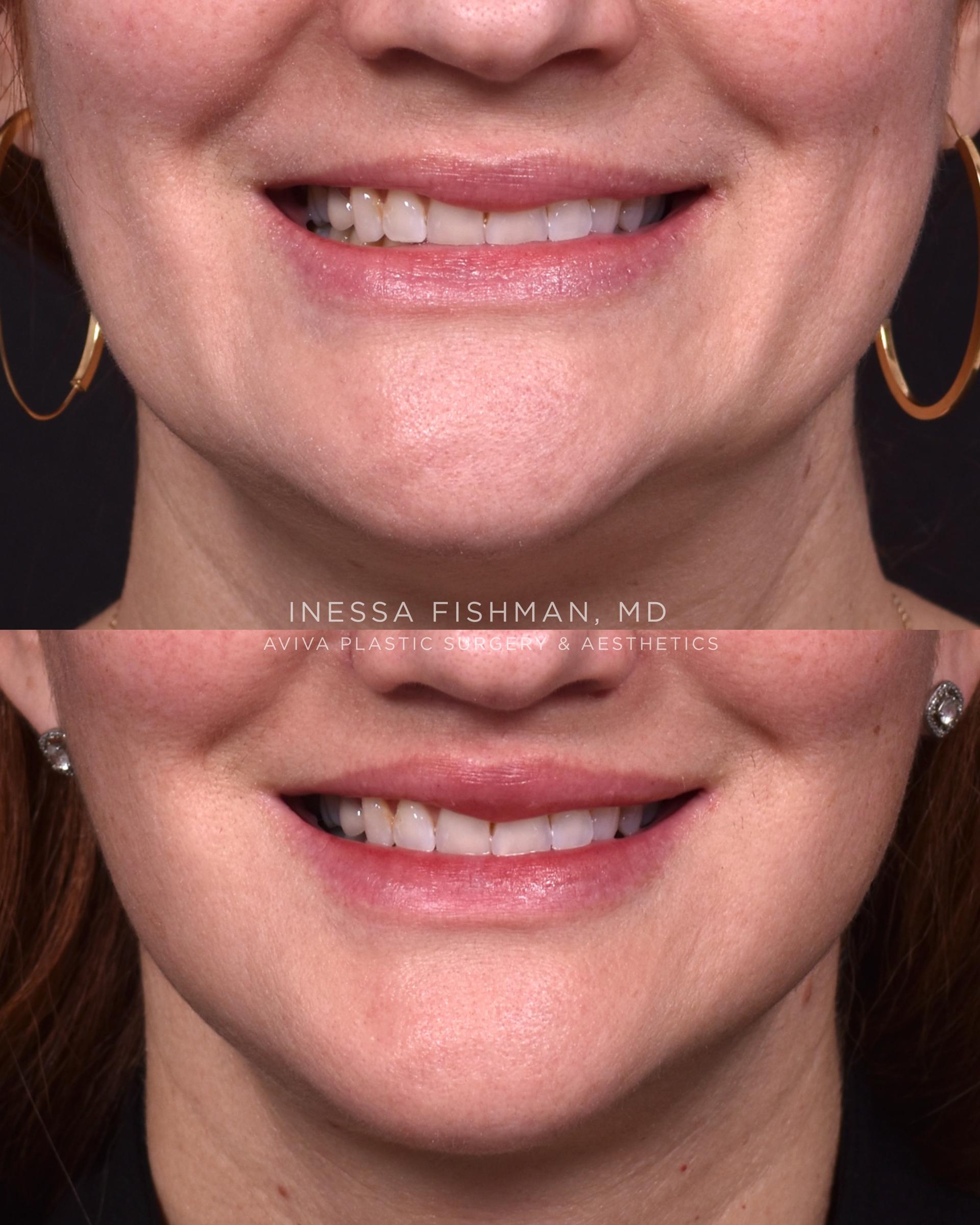 Close lip lift before-and-after from an Atlanta facial rejuvenation case