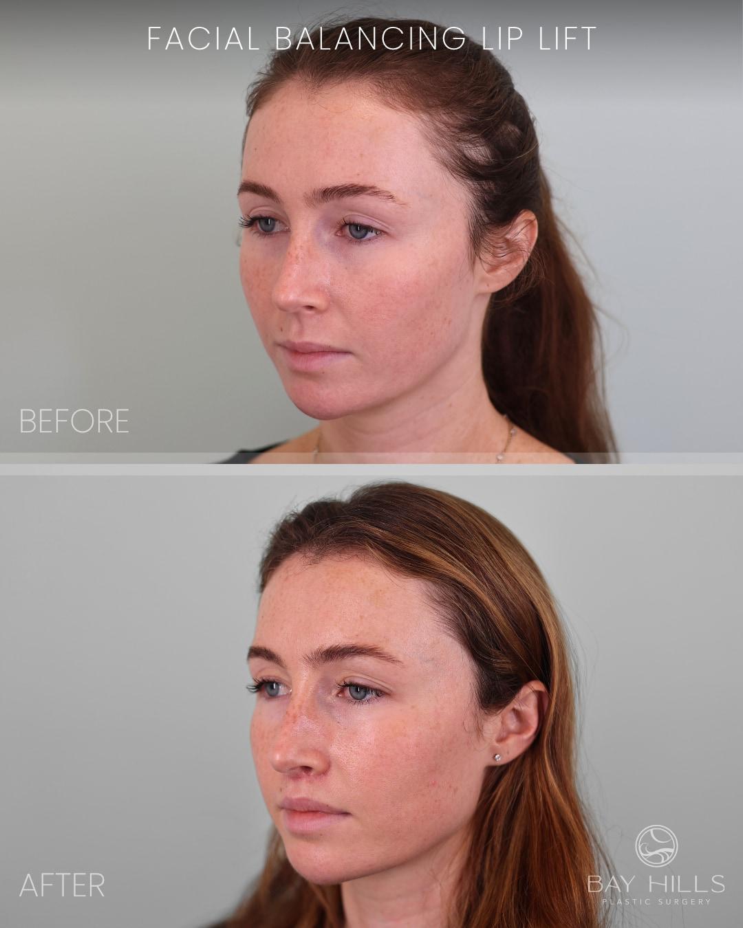 Before-and-after image from a Bay Area lip lift Reddit post