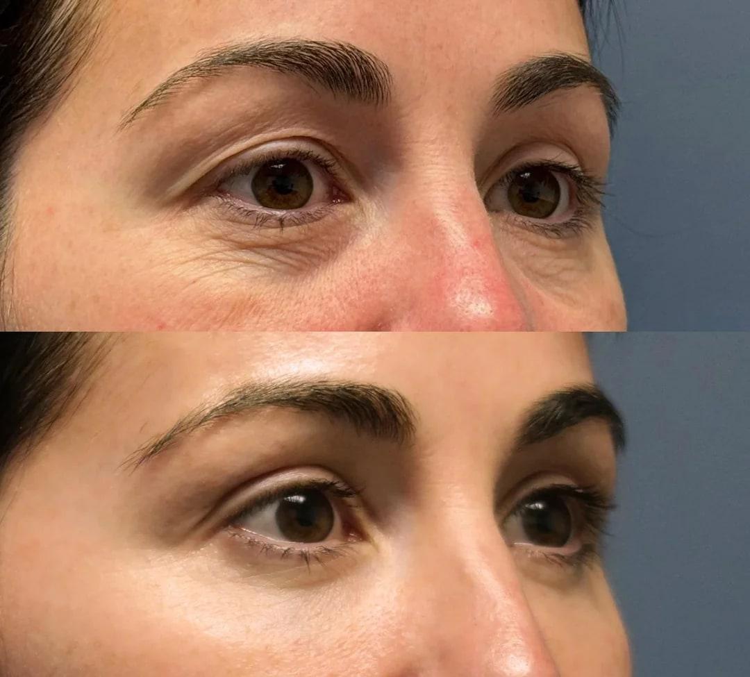 Before-and-after eye surgery comparison from a Denver blepharoplasty and fat transfer Reddit post