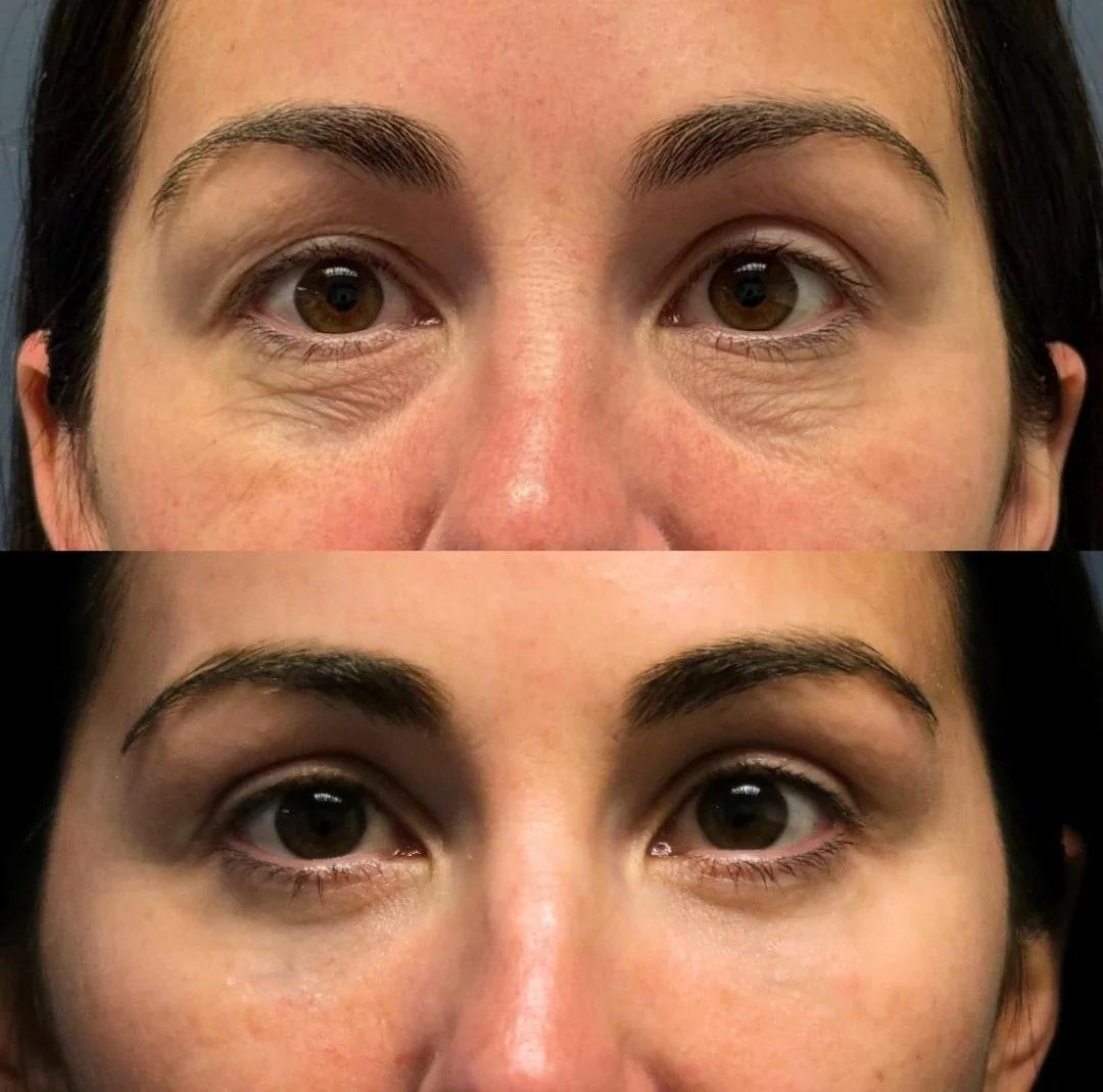 Side-by-side under-eye result after lower blepharoplasty and fat transfer