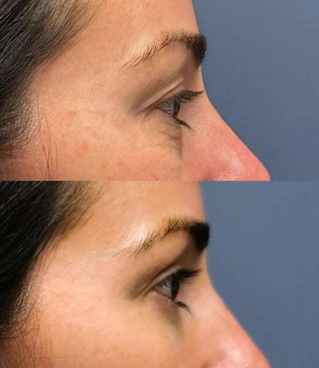 Close comparison of eyelid and cheek transition after blepharoplasty and fat transfer