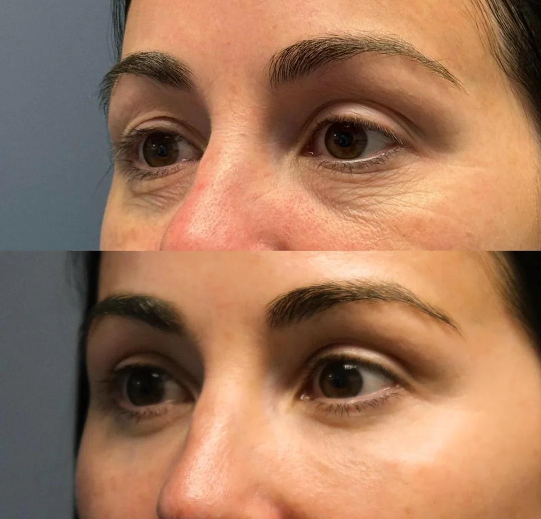 Additional before-and-after photo from a Denver eyelid surgery result