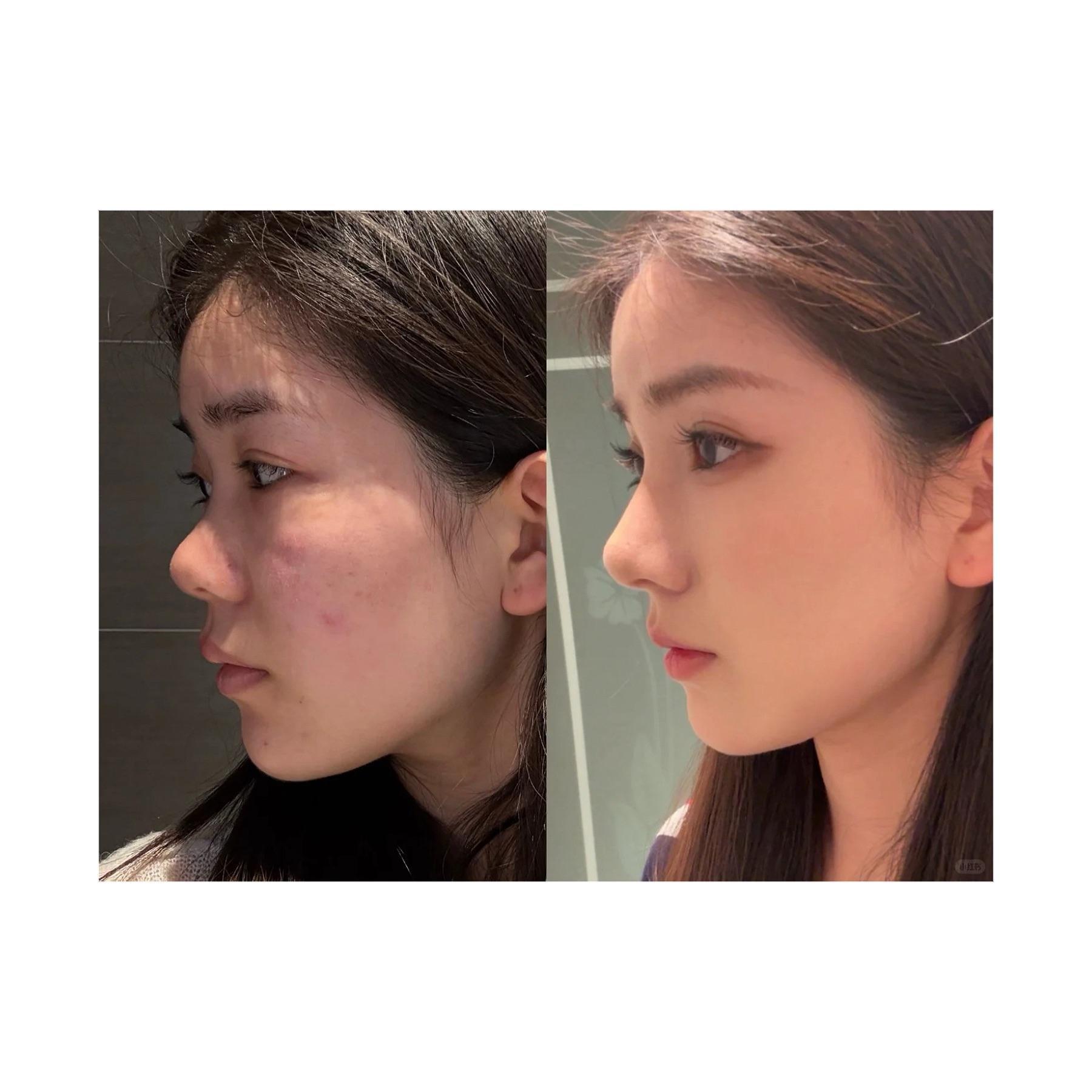 Before-and-after side profile comparison from a rhinoplasty glow-up Reddit post