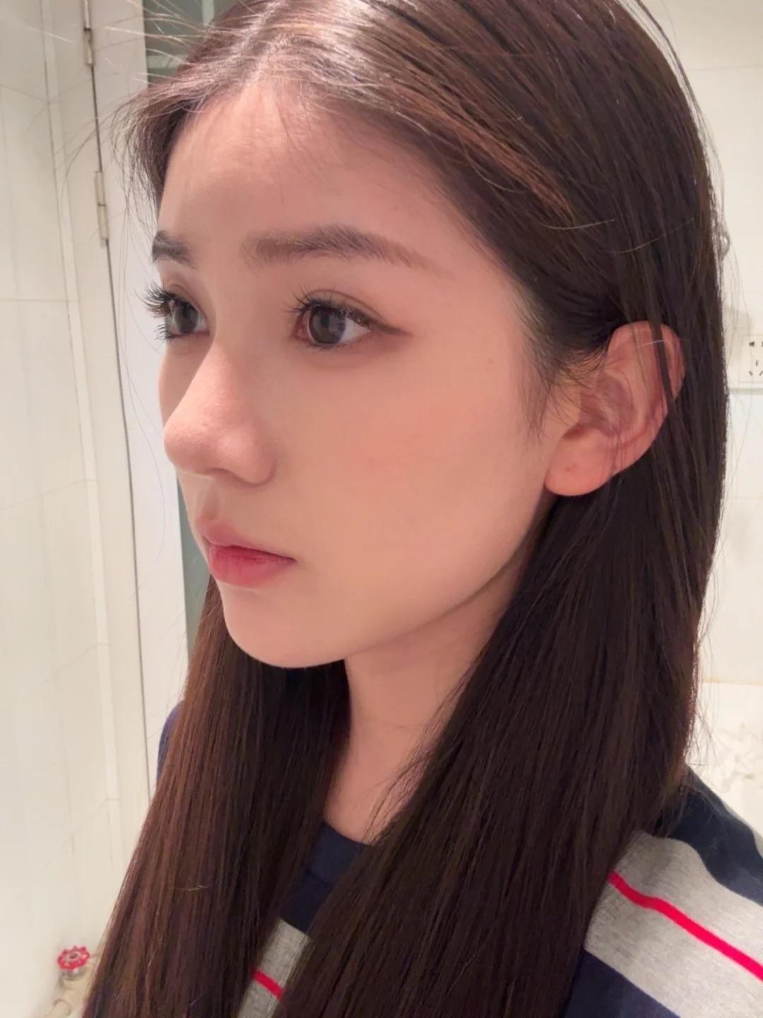 After photo from a rhinoplasty and K-beauty glow-up Reddit story