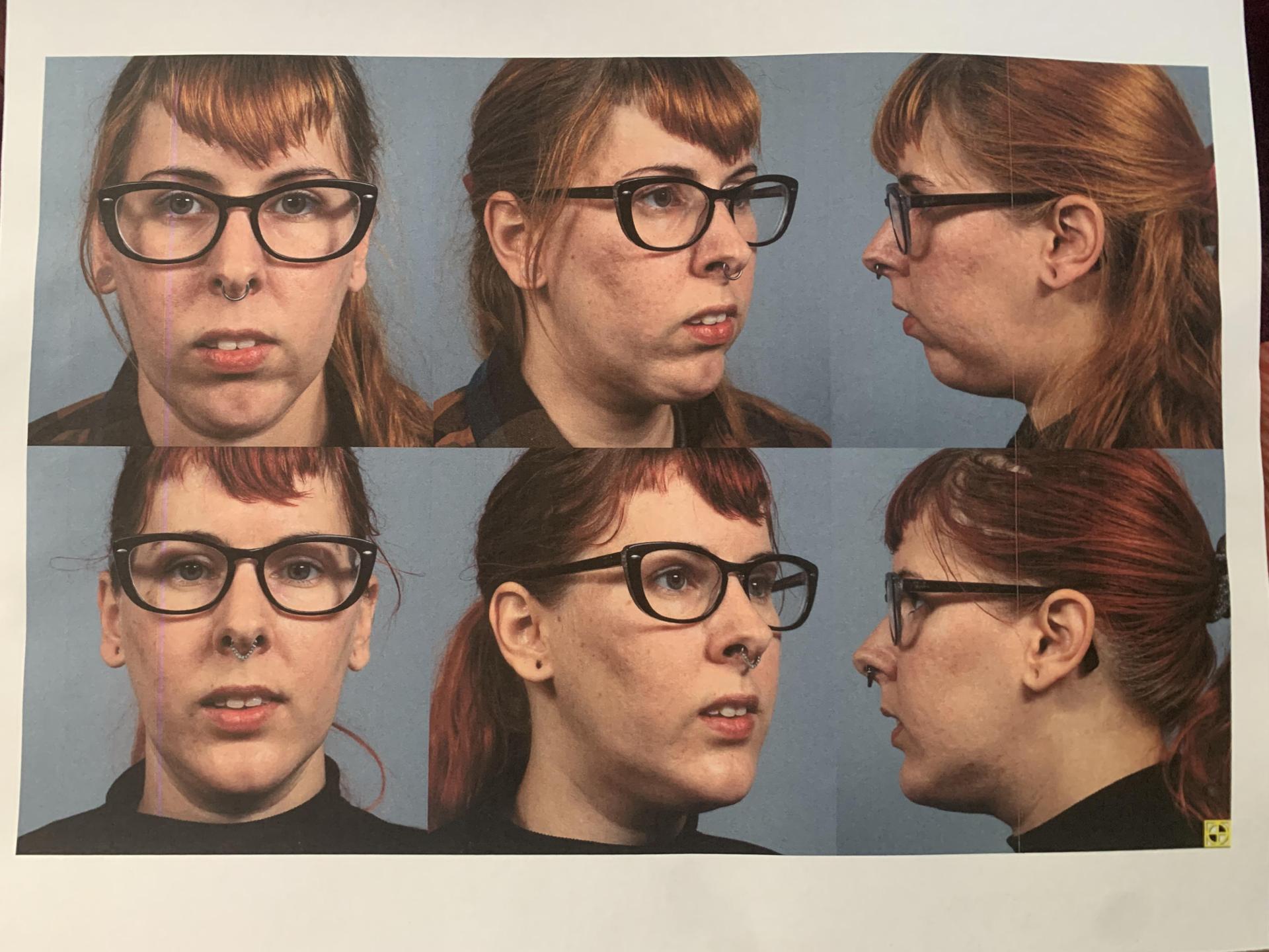 Five-view comparison before and after chin implant removal and sliding genioplasty