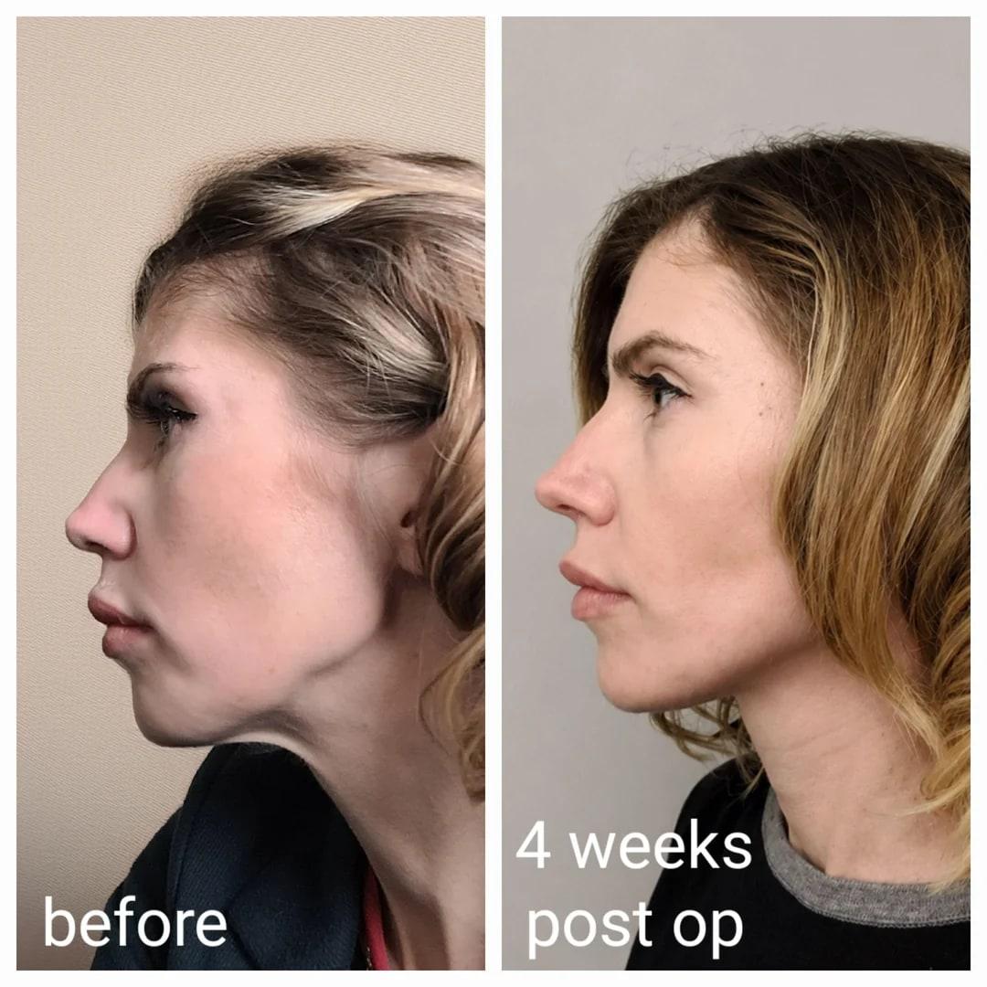 Before and after profile comparison at four weeks after deep plane face and neck lift