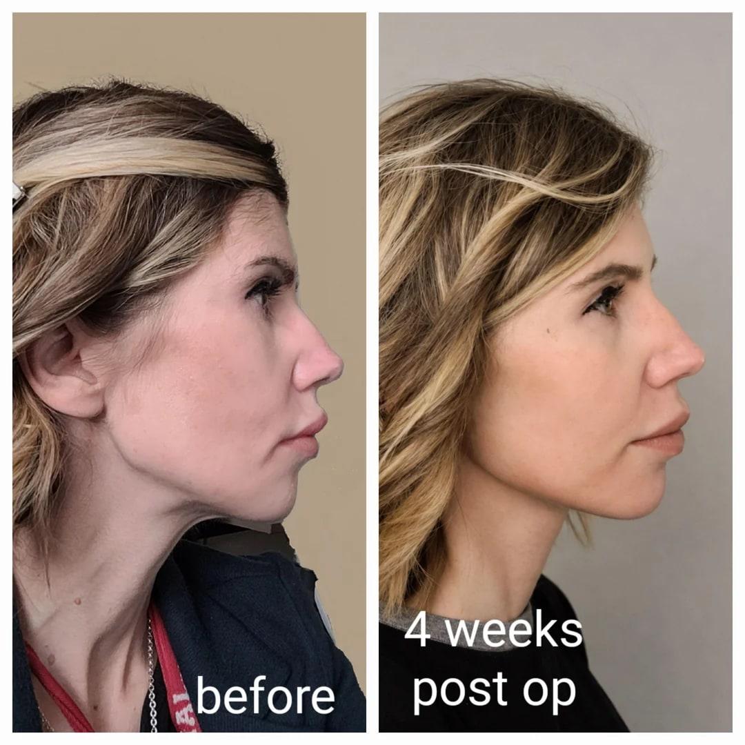 Four-week after photo from a deep plane face and neck lift patient story