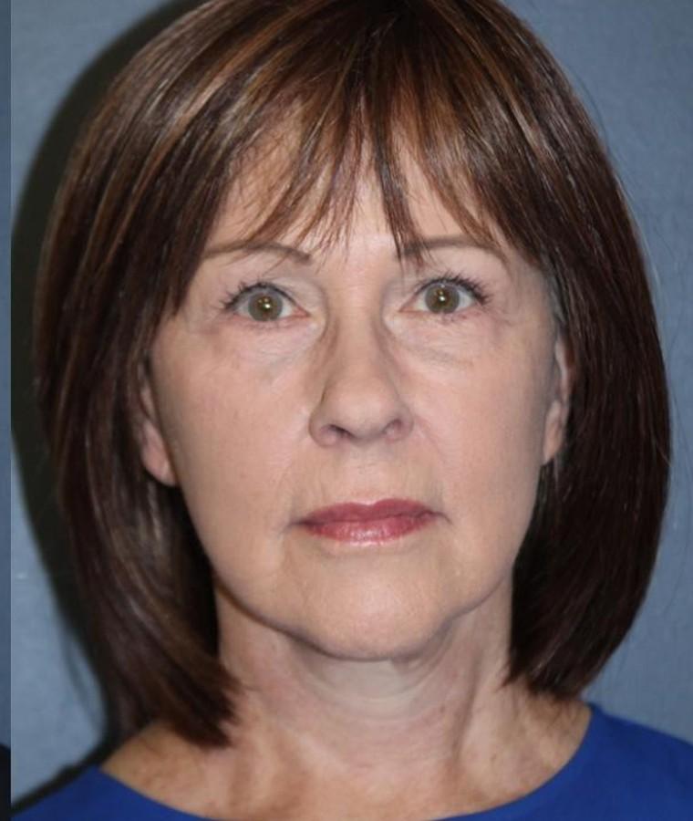 Facelift result browsing card