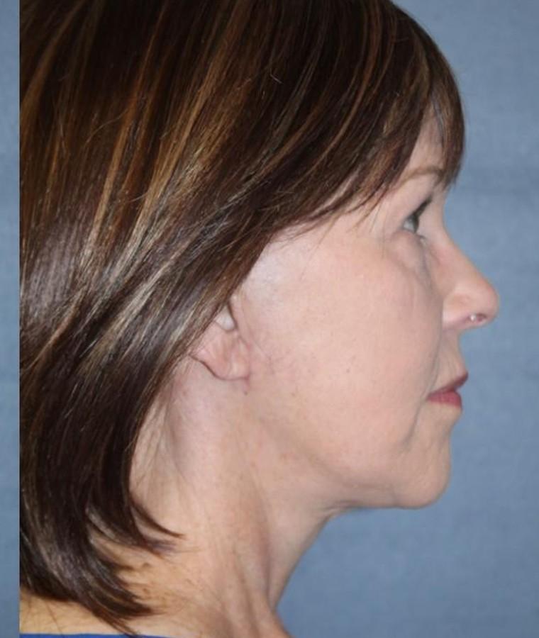 Two-month after profile from a deep plane face and neck lift result