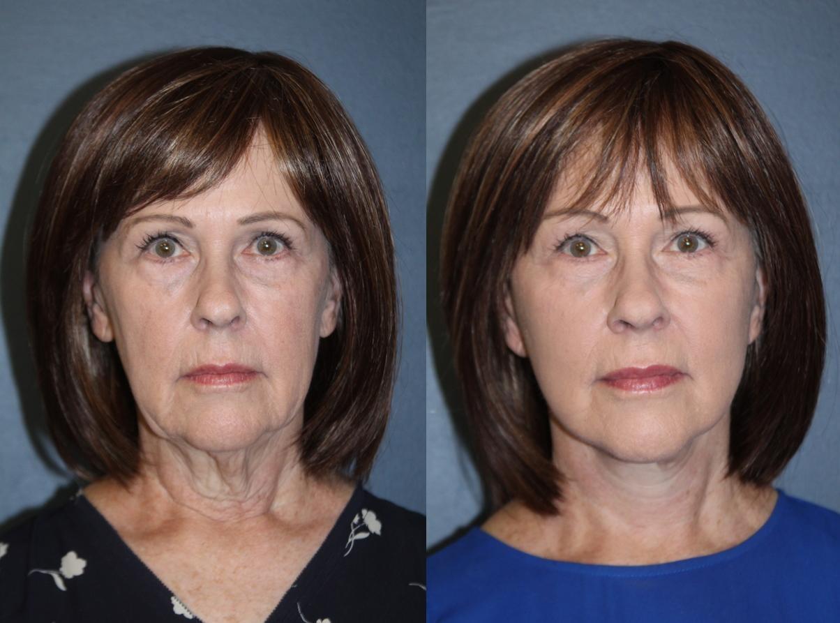 Front view before-and-after from a deep plane face and neck lift result