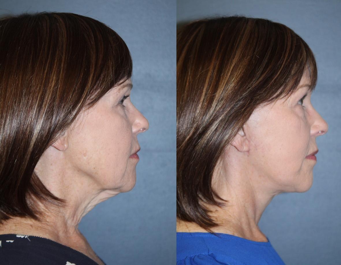 Profile before-and-after from a Denver deep plane face and neck lift result