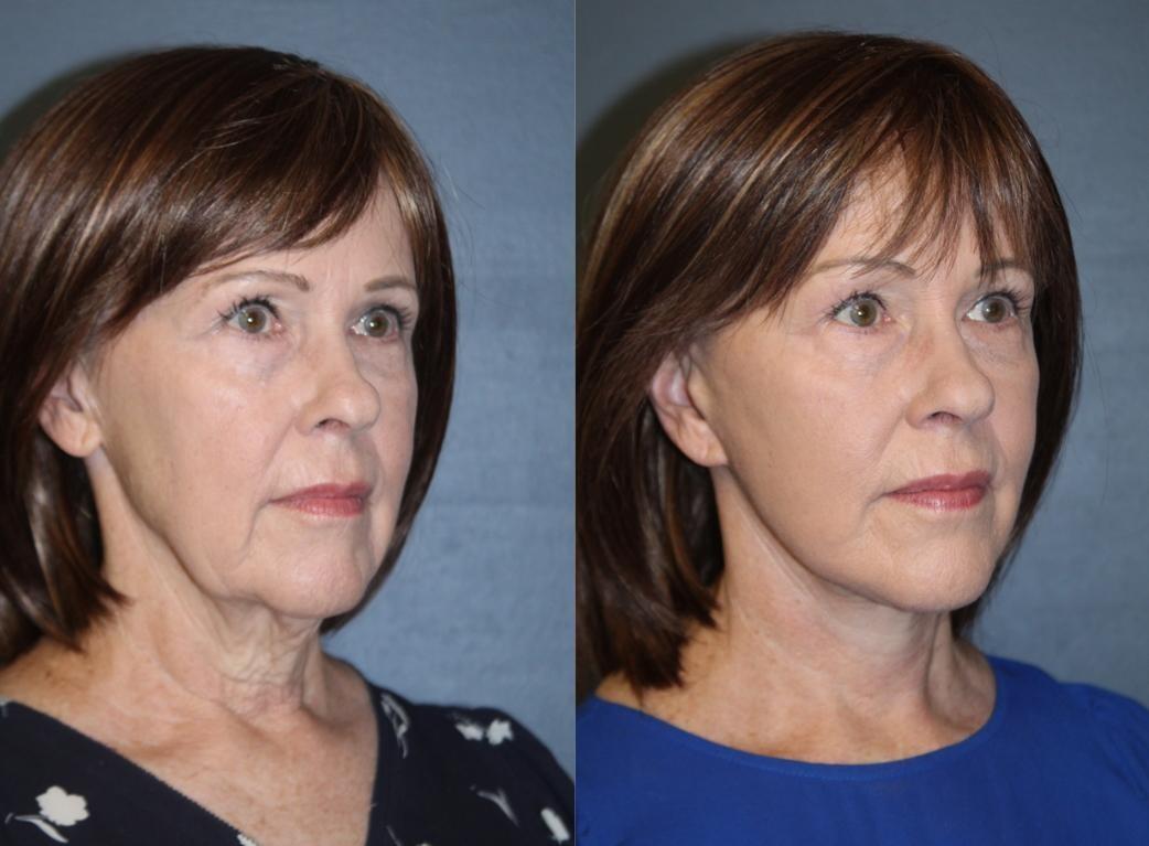 Three-quarter before-and-after from a deep plane face and neck lift result