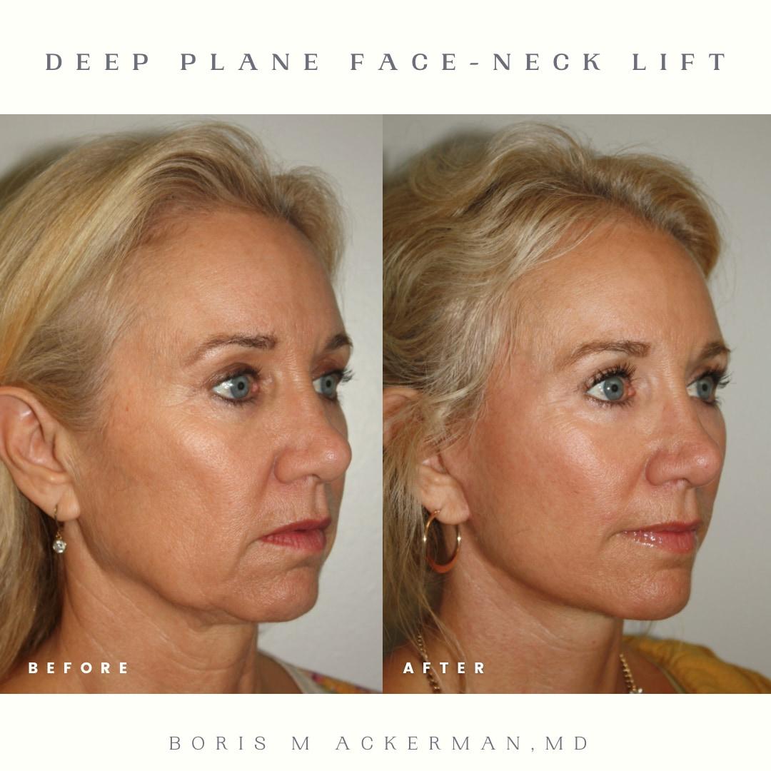 Side view before-and-after from a deep plane face and neck lift at 12 months