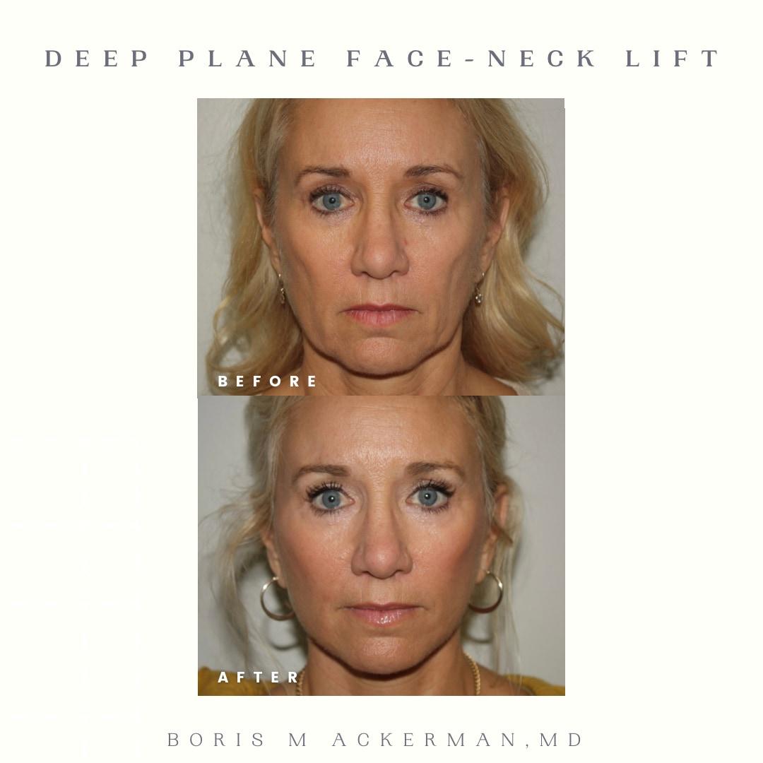 Front before-and-after from an Orange County deep plane face and neck lift at 12 months