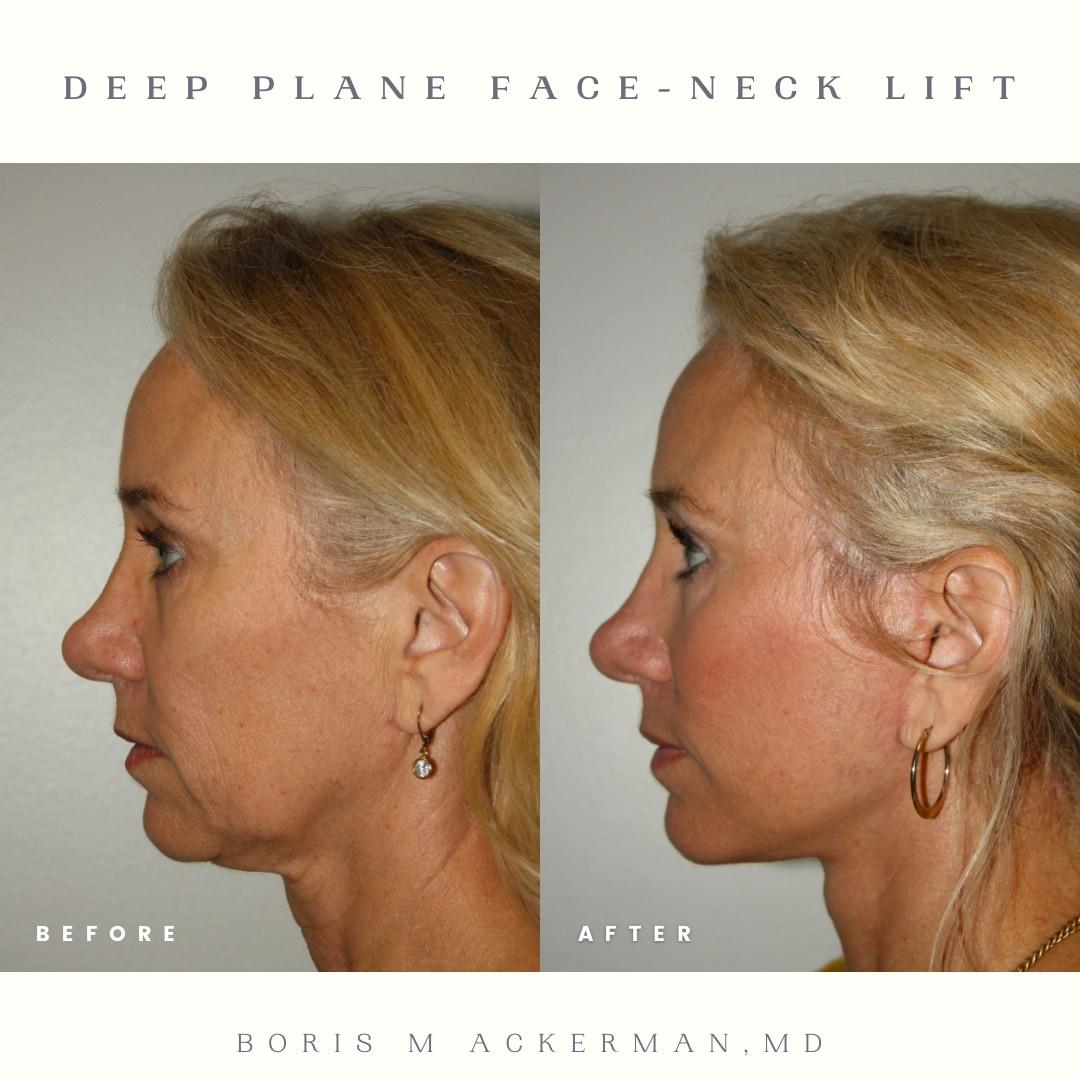 Profile before-and-after showing neck contour after deep plane face and neck lift