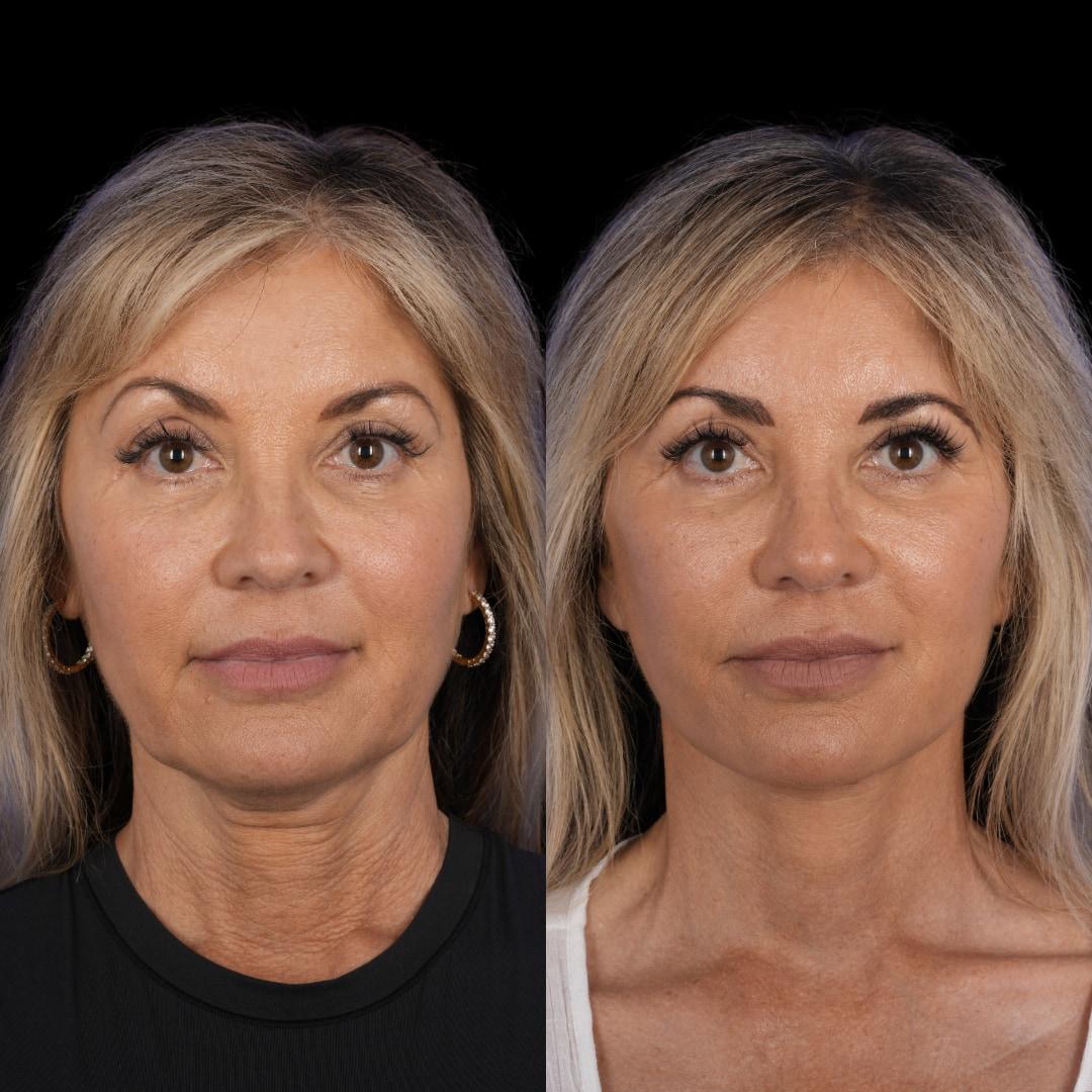 Front before-and-after after deep plane facelift and fat grafting at 2 months