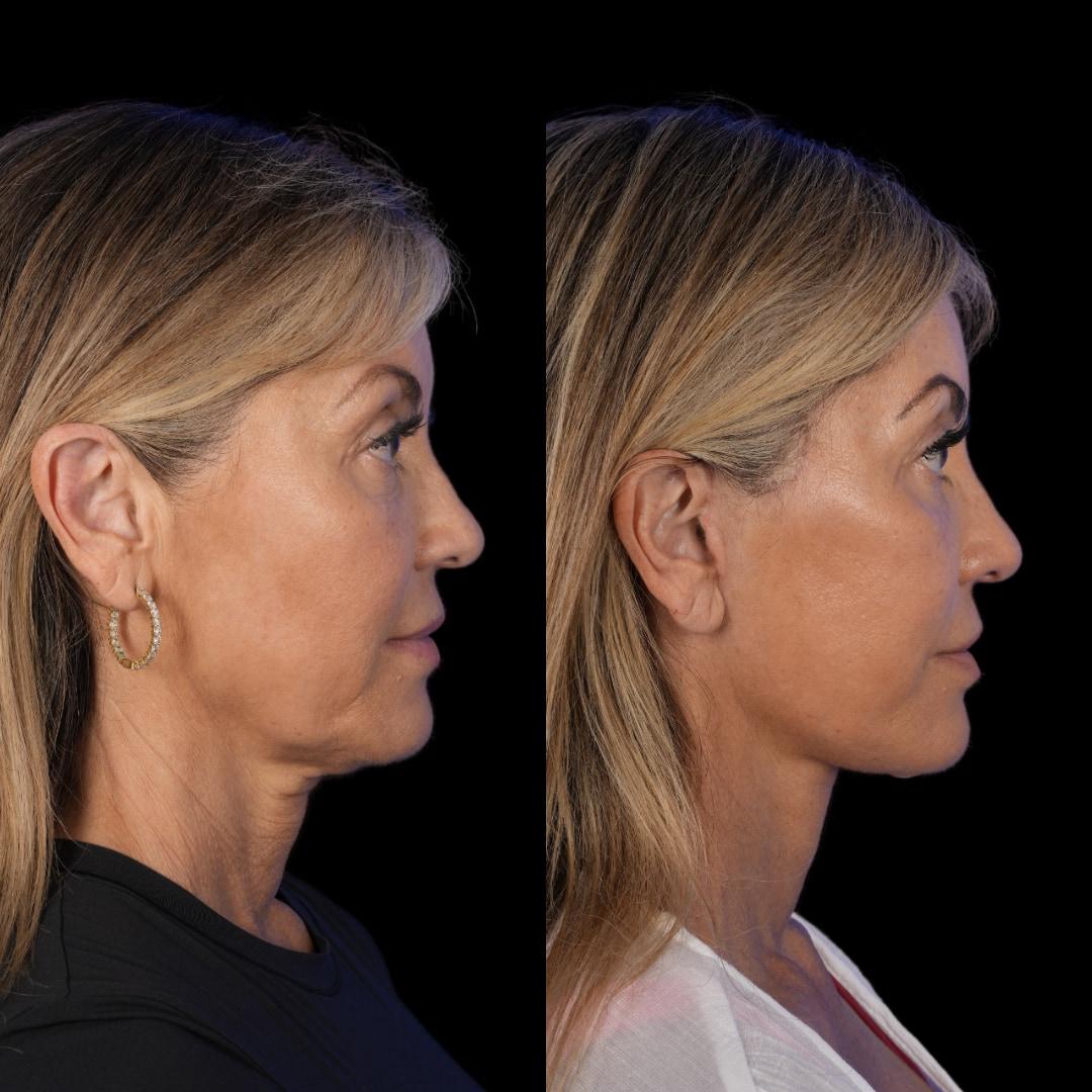 Profile before-and-after after deep plane facelift at 2 months
