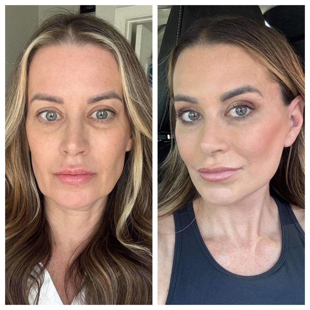 Front-view before and after photos from a 3.5-month facelift patient story