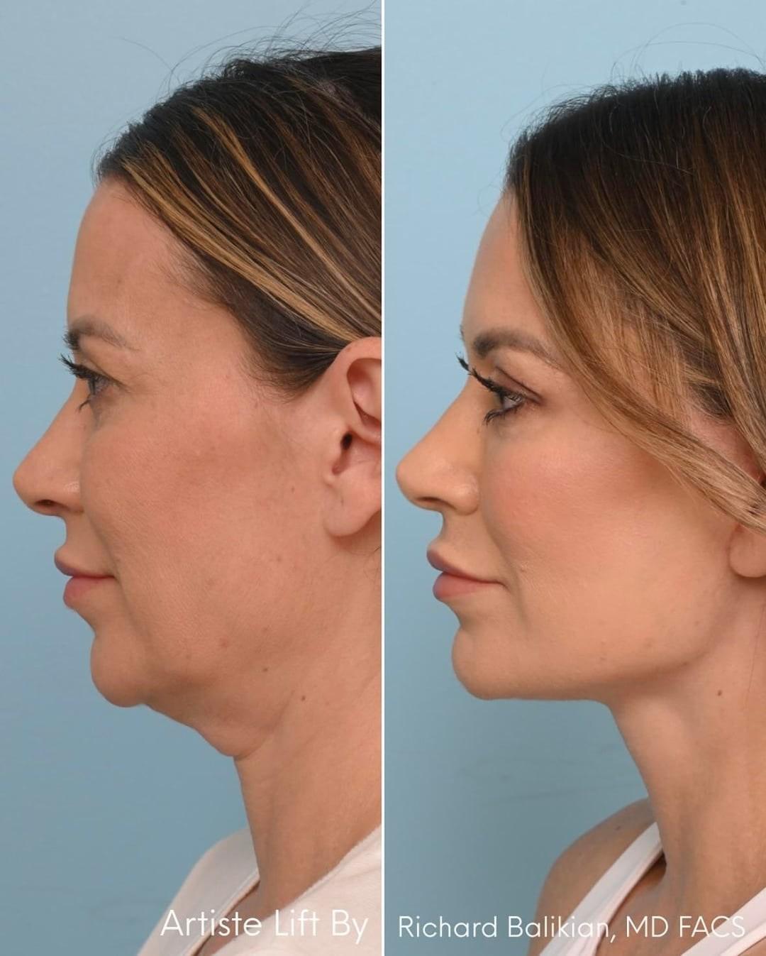 Side-profile before and after photos from a deep plane facelift patient story