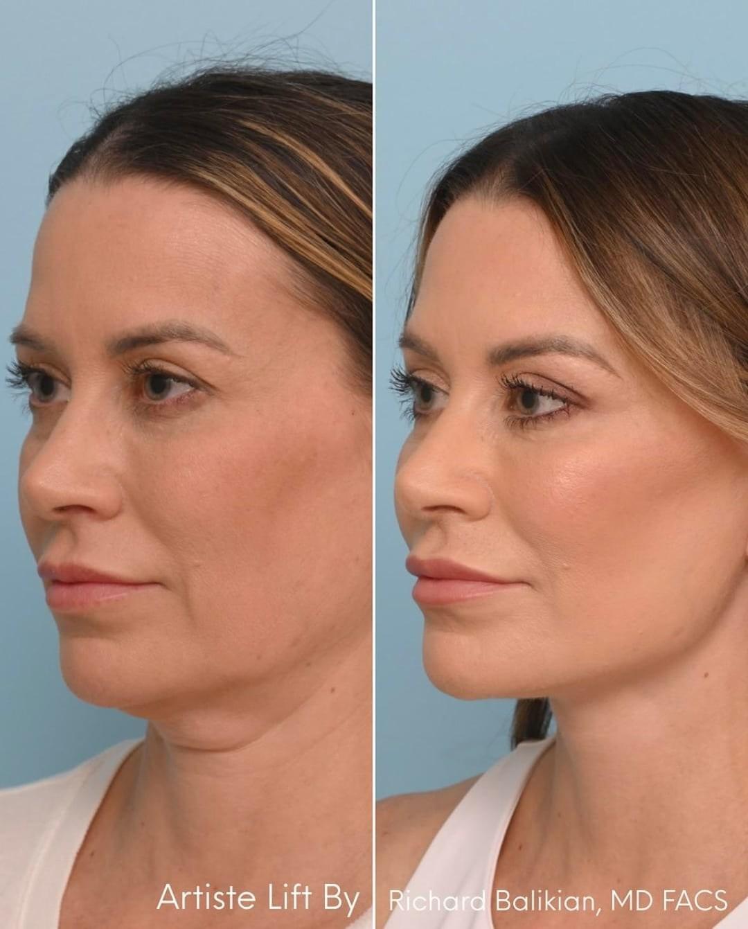Three-quarter before and after photos from a deep plane facelift patient story