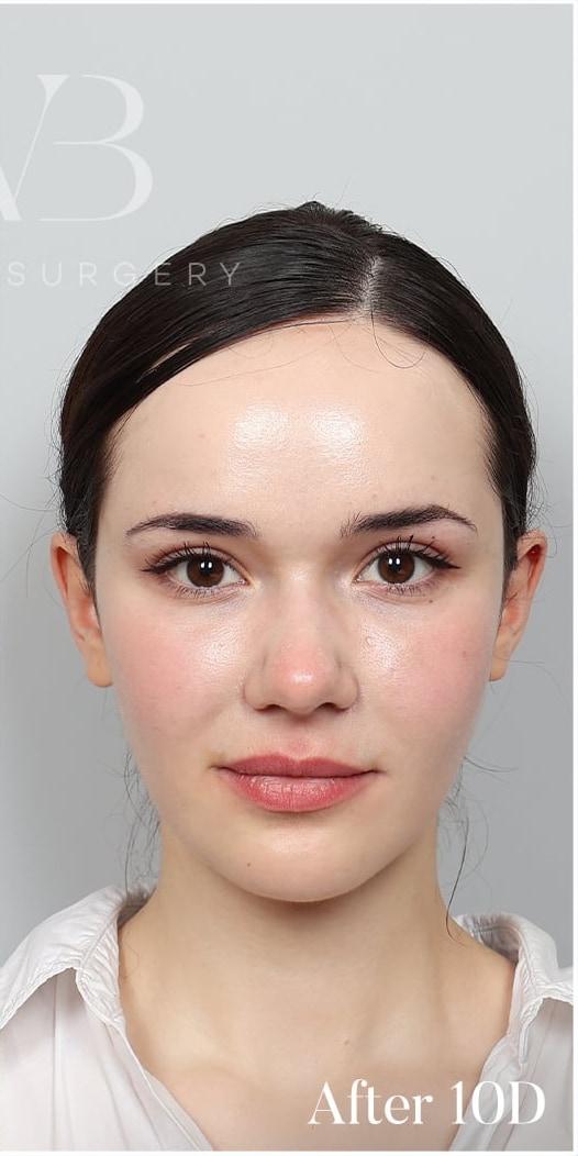Front after photo 10 days after full-face fat grafting