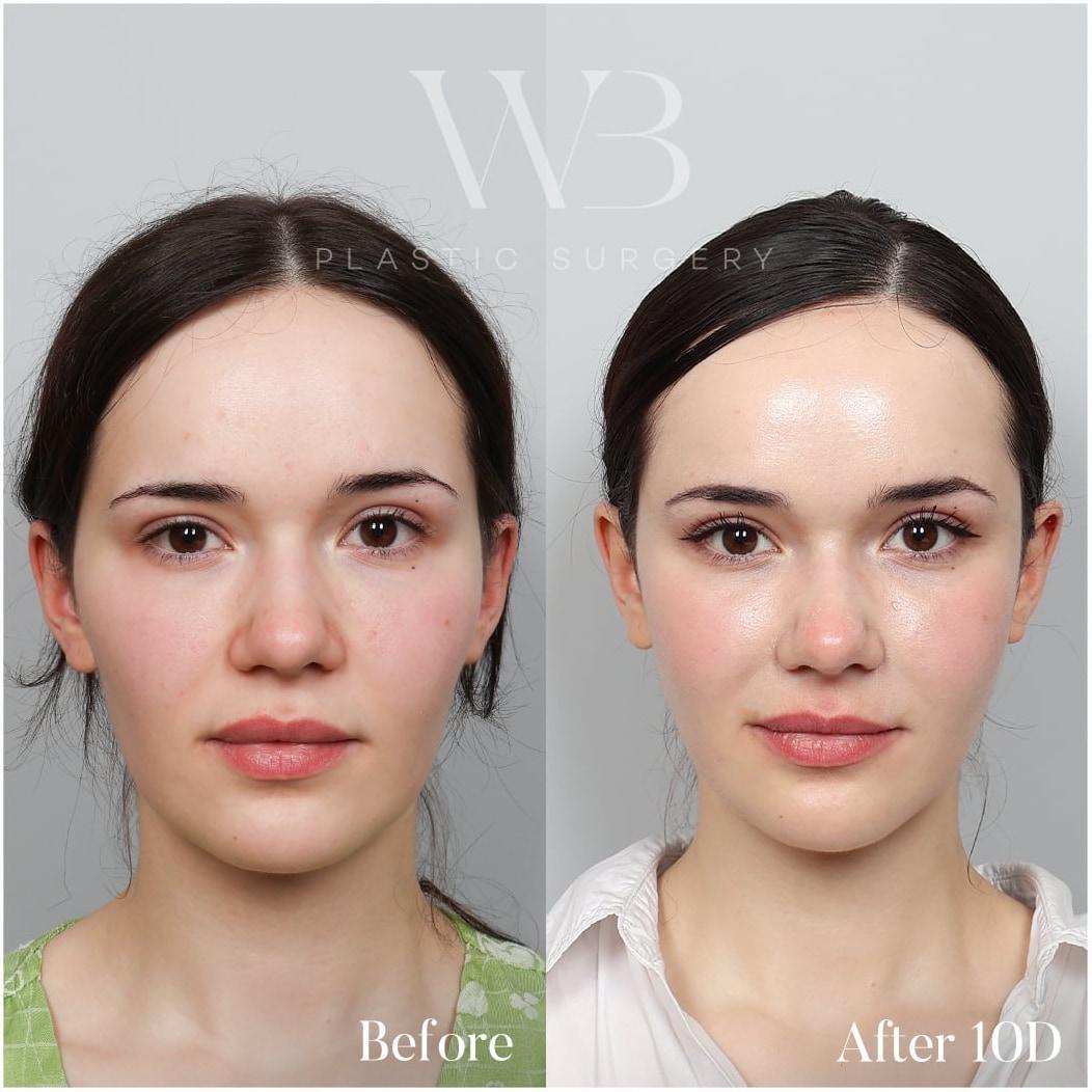 Front before-and-after from a full-face fat graft result 10 days after surgery