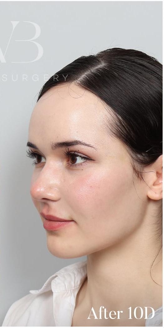Profile after photo 10 days after full-face fat grafting