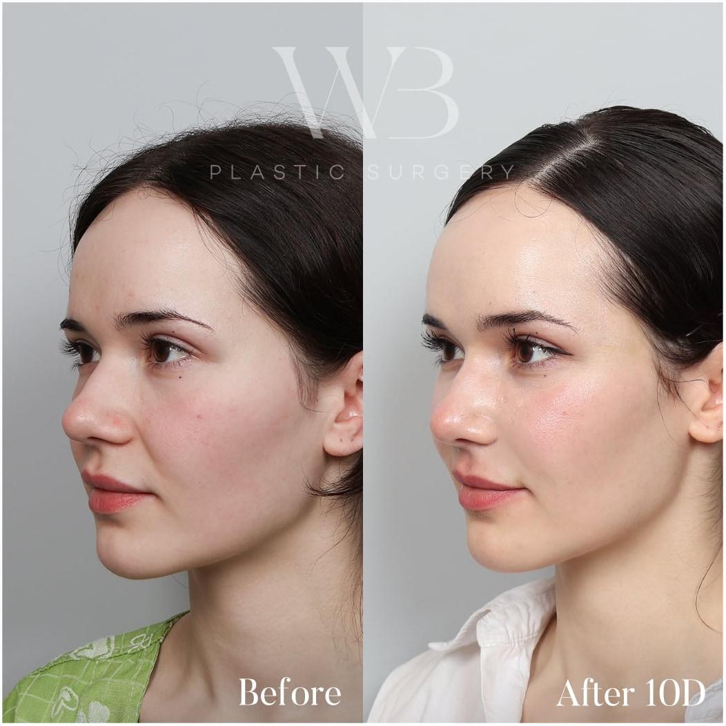 Profile before-and-after from a full-face fat graft result 10 days after surgery