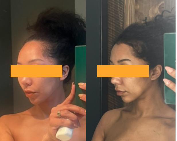 Side-by-side profile before hairline lowering and five months after