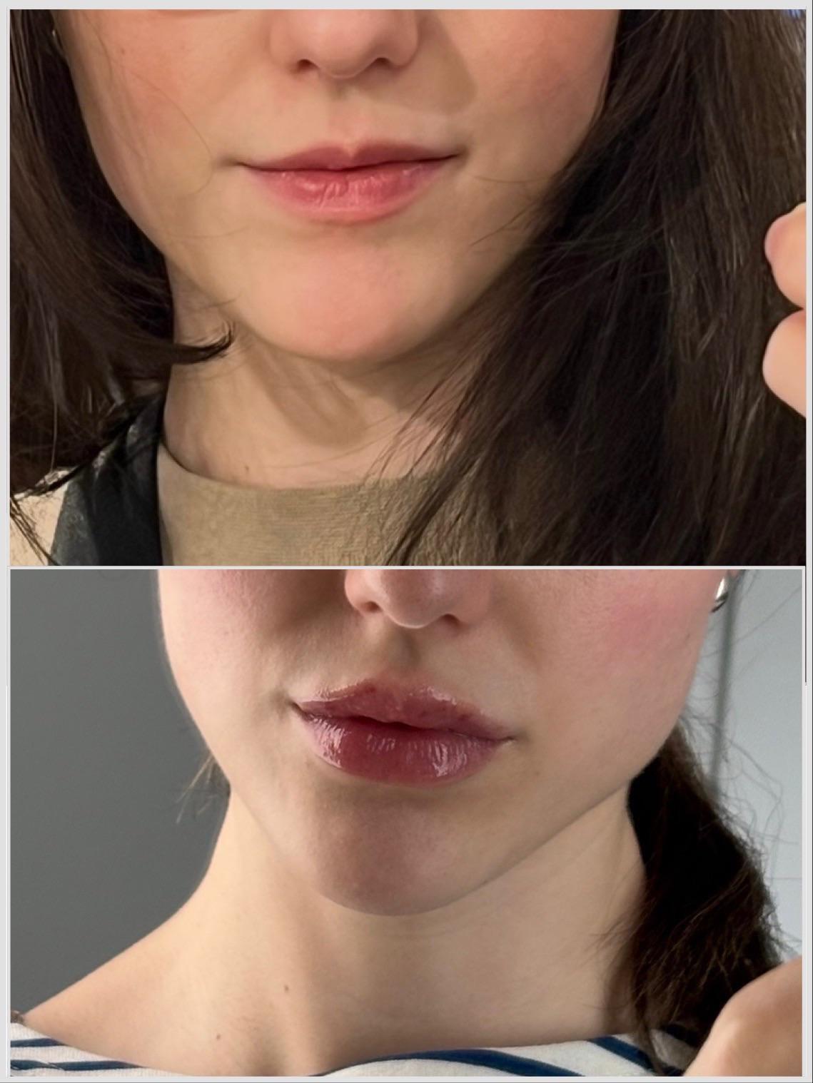 Lip filler before-and-after comparison from a Reddit patient story