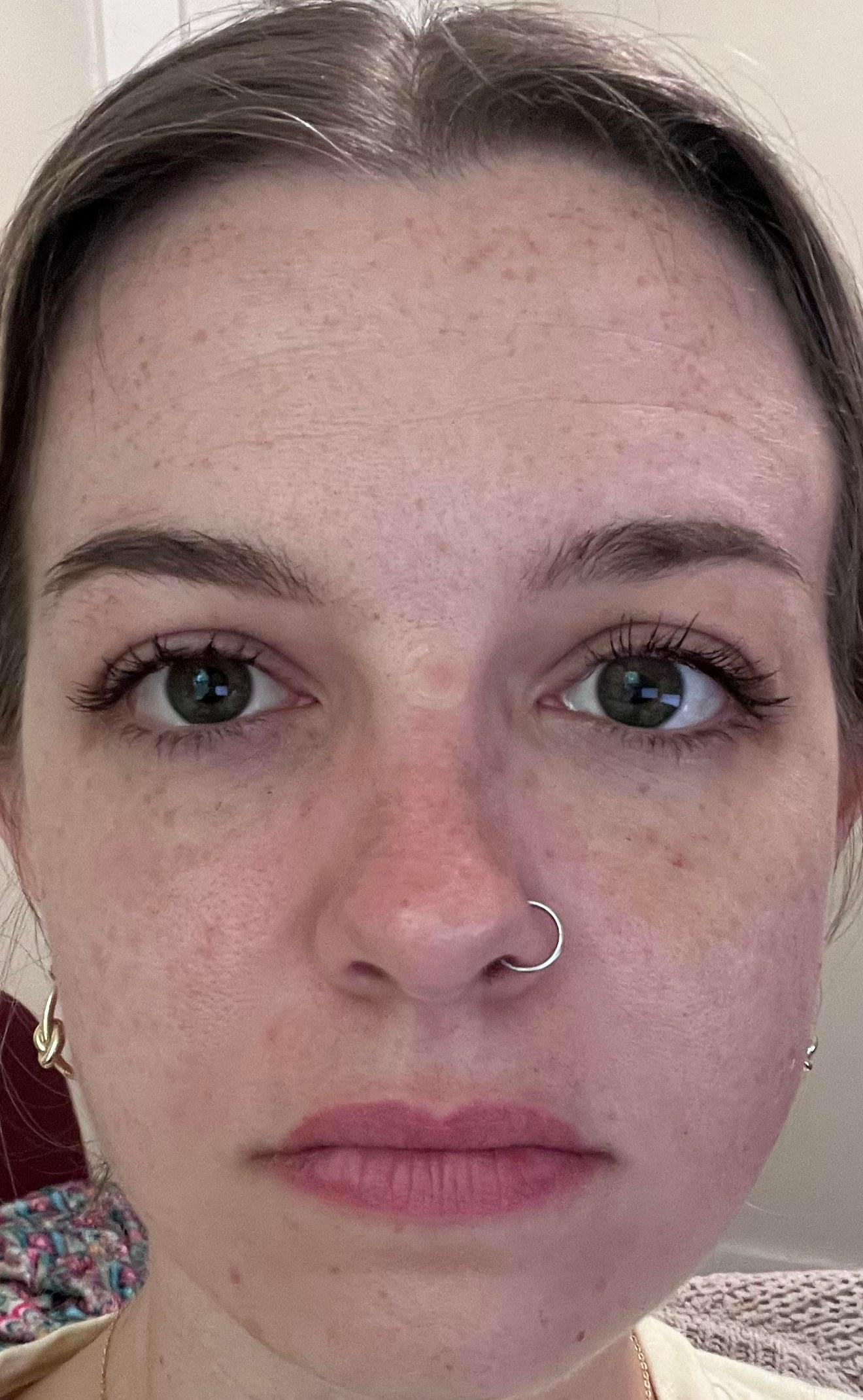 Three-week post-op photo from a lower blepharoplasty and fat transfer patient story