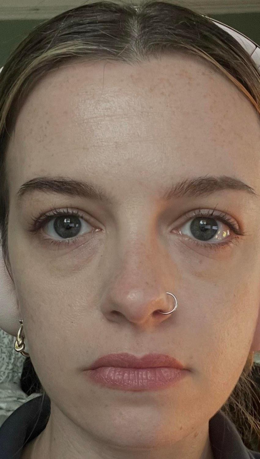 Before photo from a lower blepharoplasty and fat transfer patient story