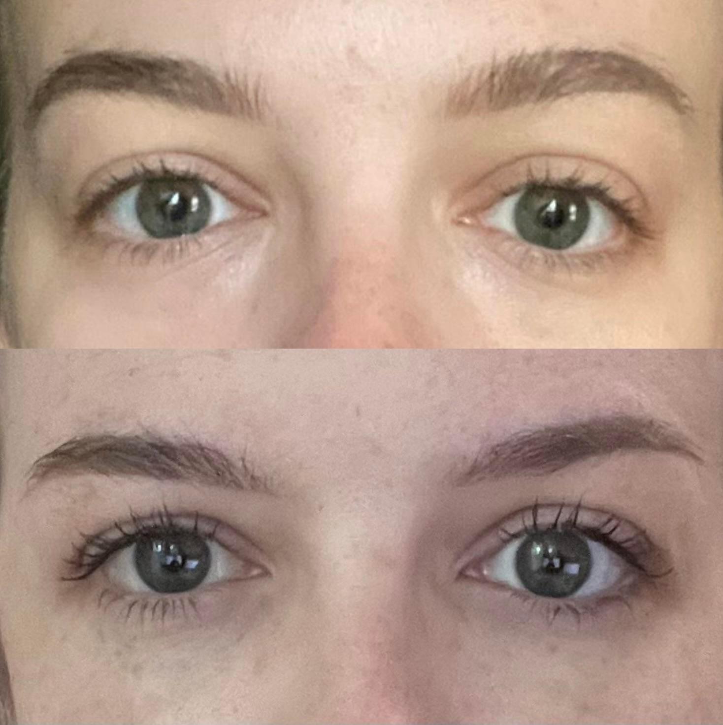 Before-and-after close-up showing lower blepharoplasty and fat transfer change around the eyes