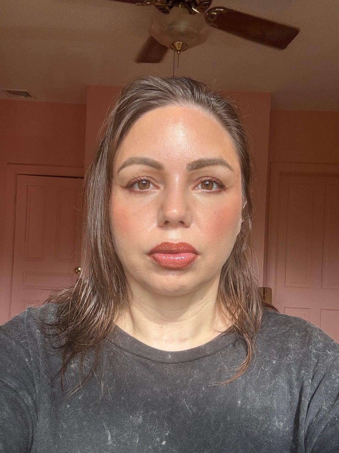 Current lower-blepharoplasty result with makeup