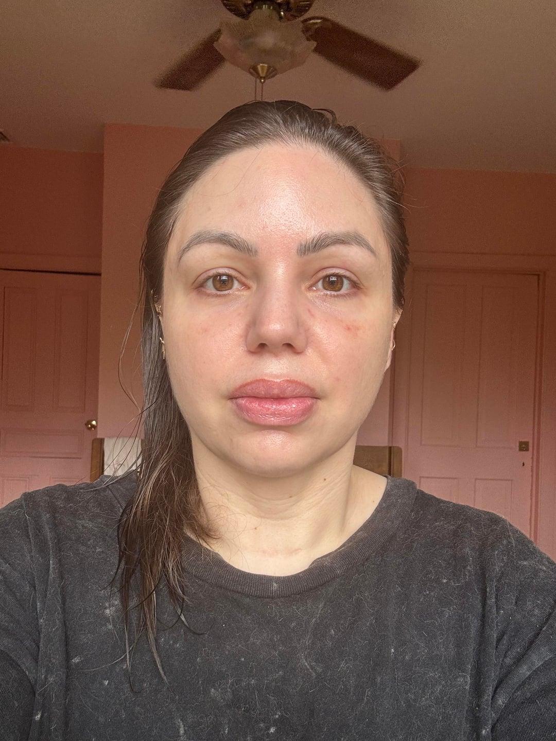 Current lower-blepharoplasty result without makeup