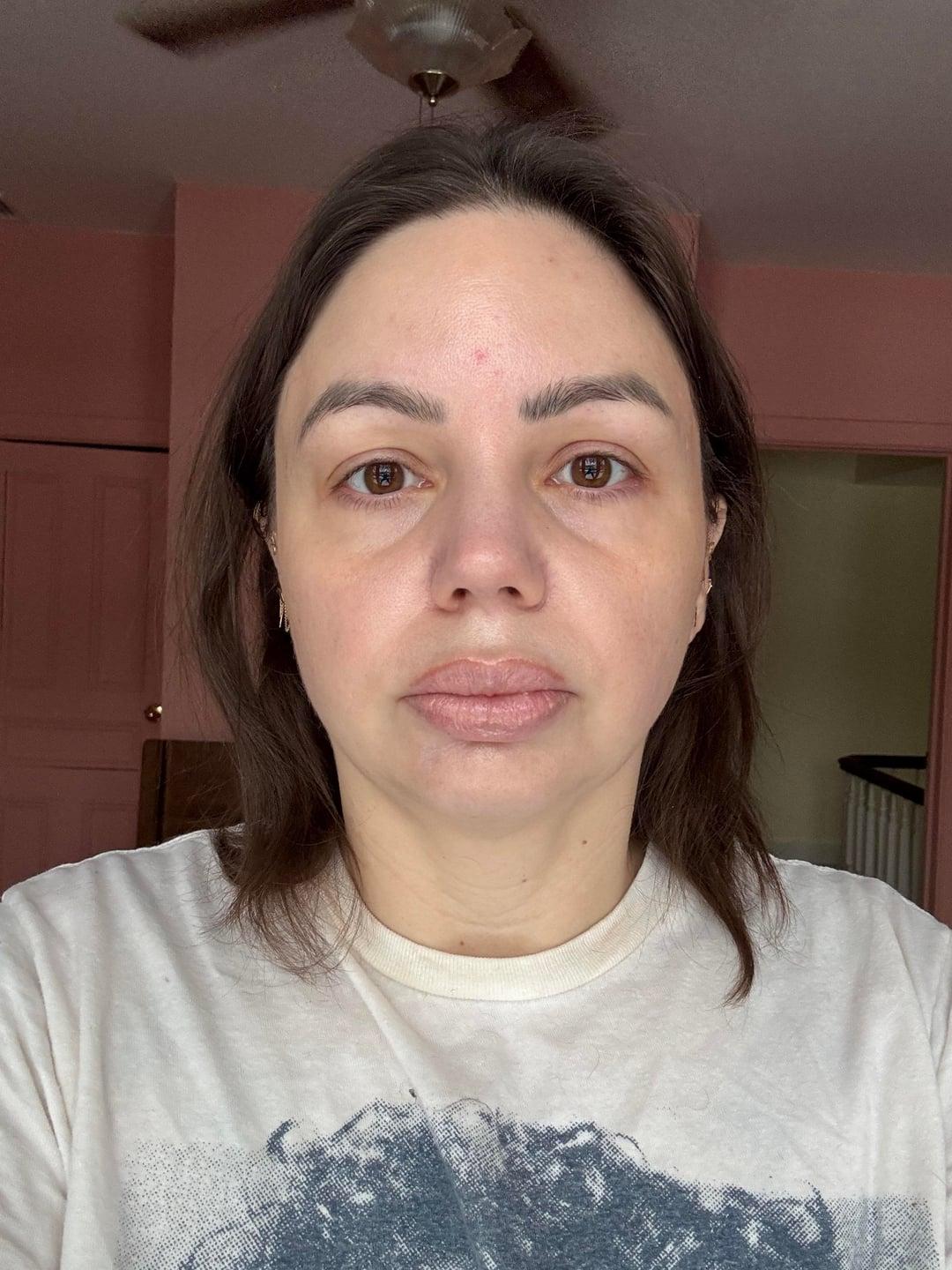 Preoperative lower-eyelid photo without makeup