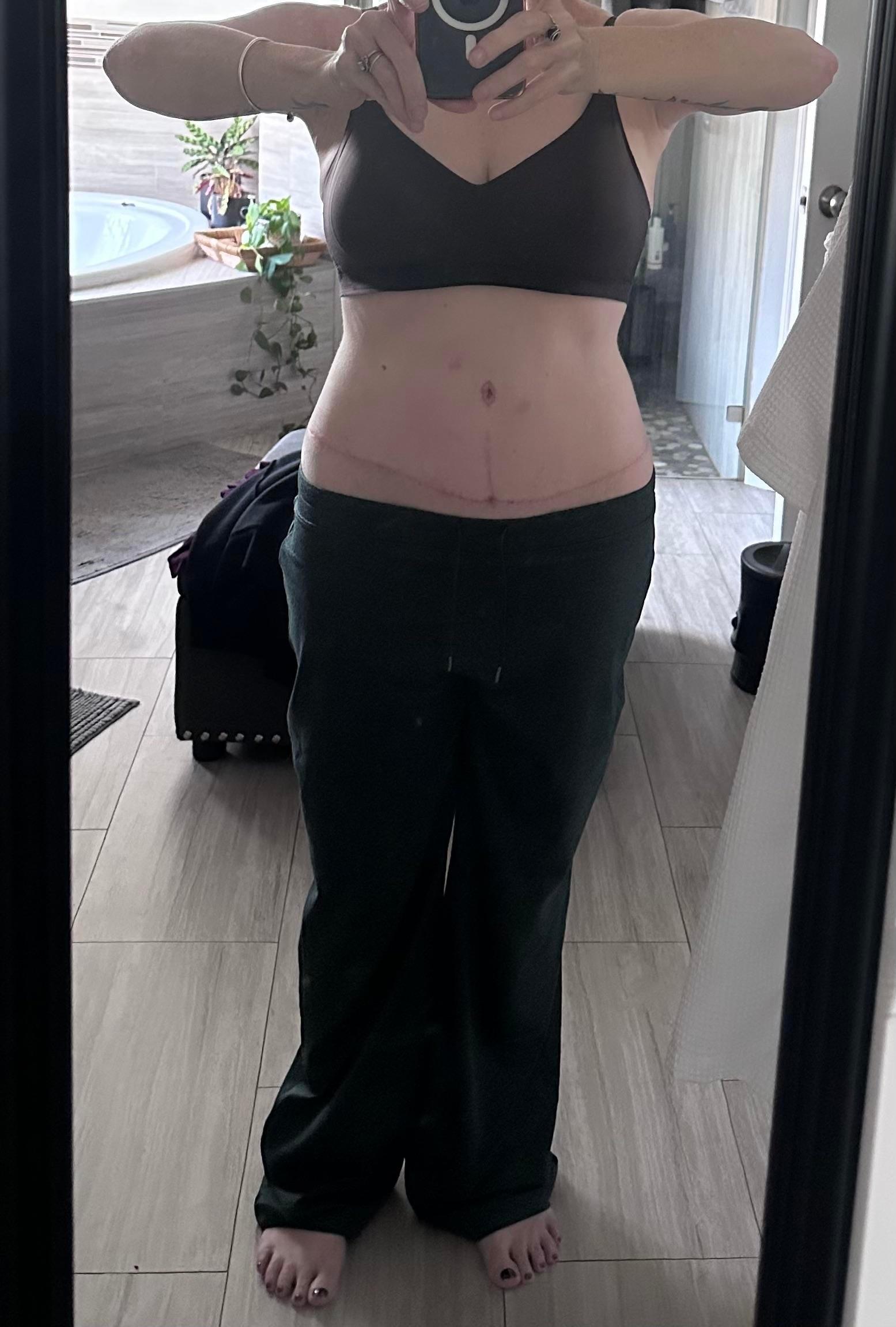 Seven-week back view after lower body lift shared on Reddit