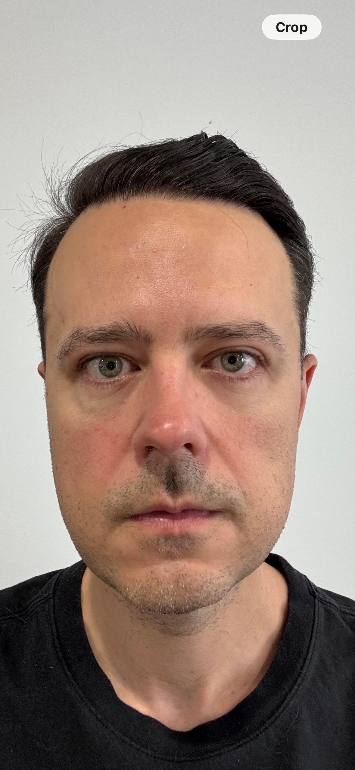 Preoperative profile photograph shared by the Reddit poster
