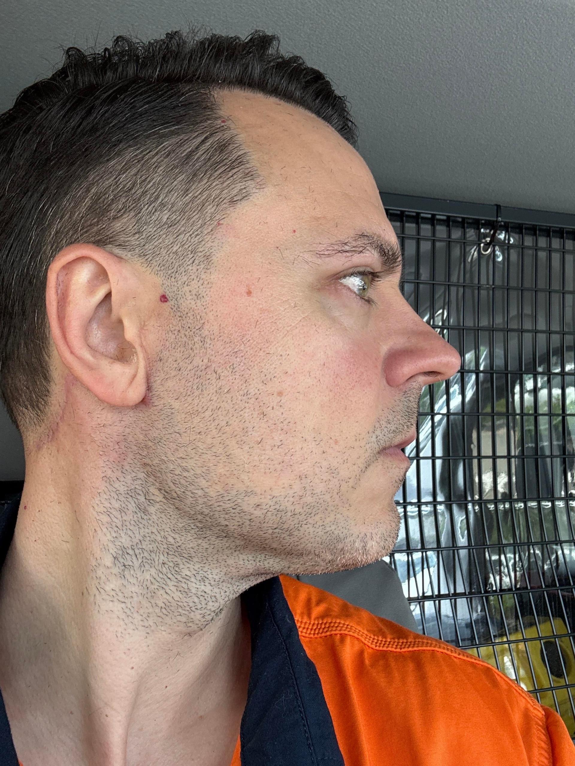 Front facial comparison shared by the Reddit poster