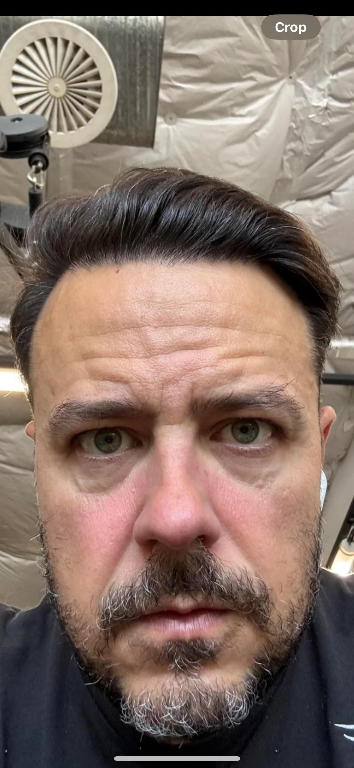 Additional face and neck result photograph shared by the Reddit poster