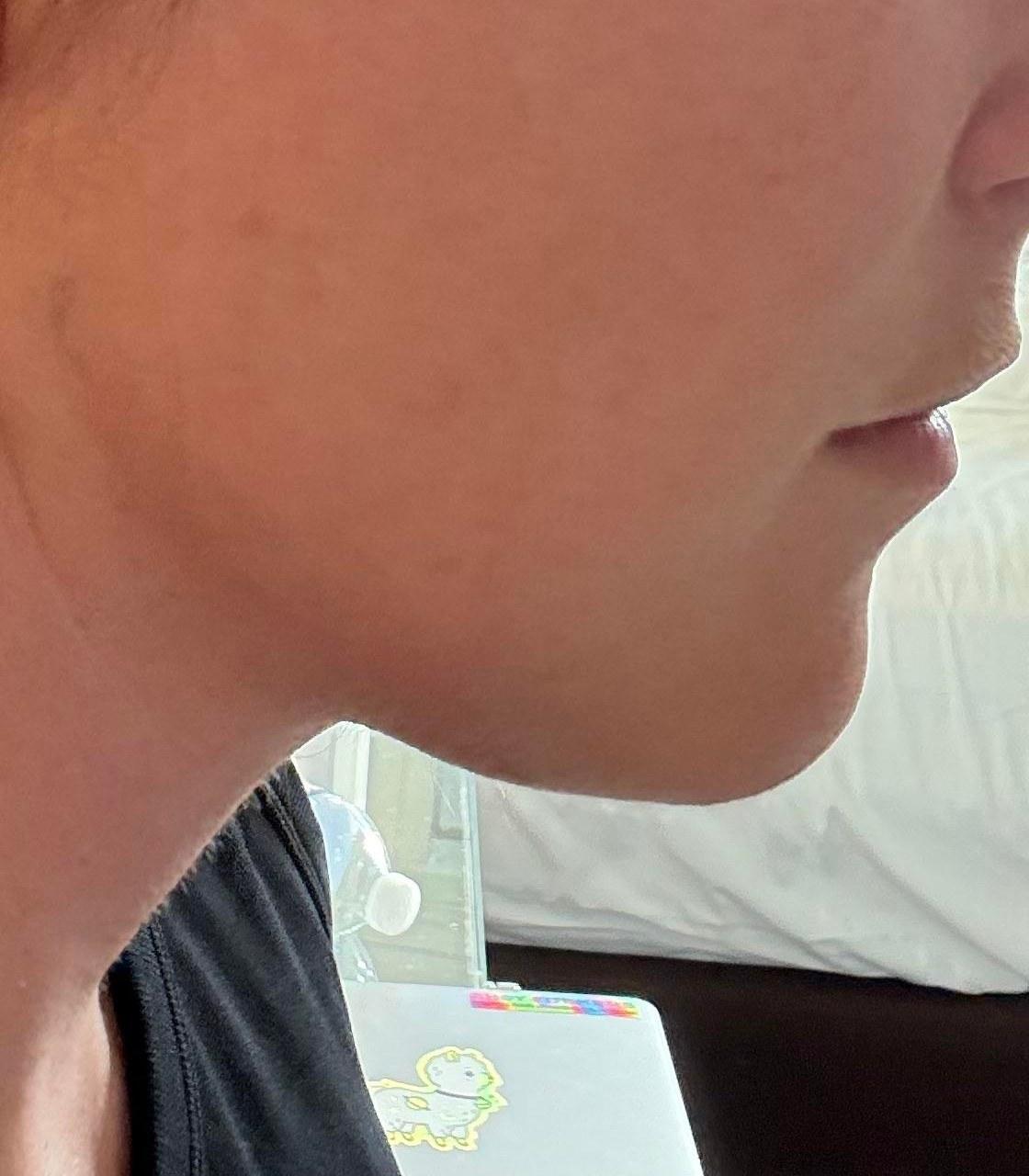 Close profile crop showing jawline and neck after a deep plane neck lift