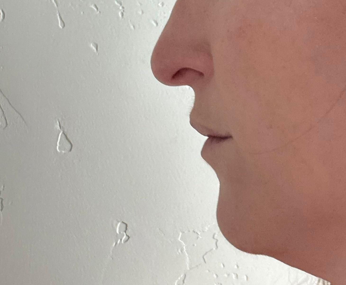 3.5-week profile crop from a deep plane neck lift patient story